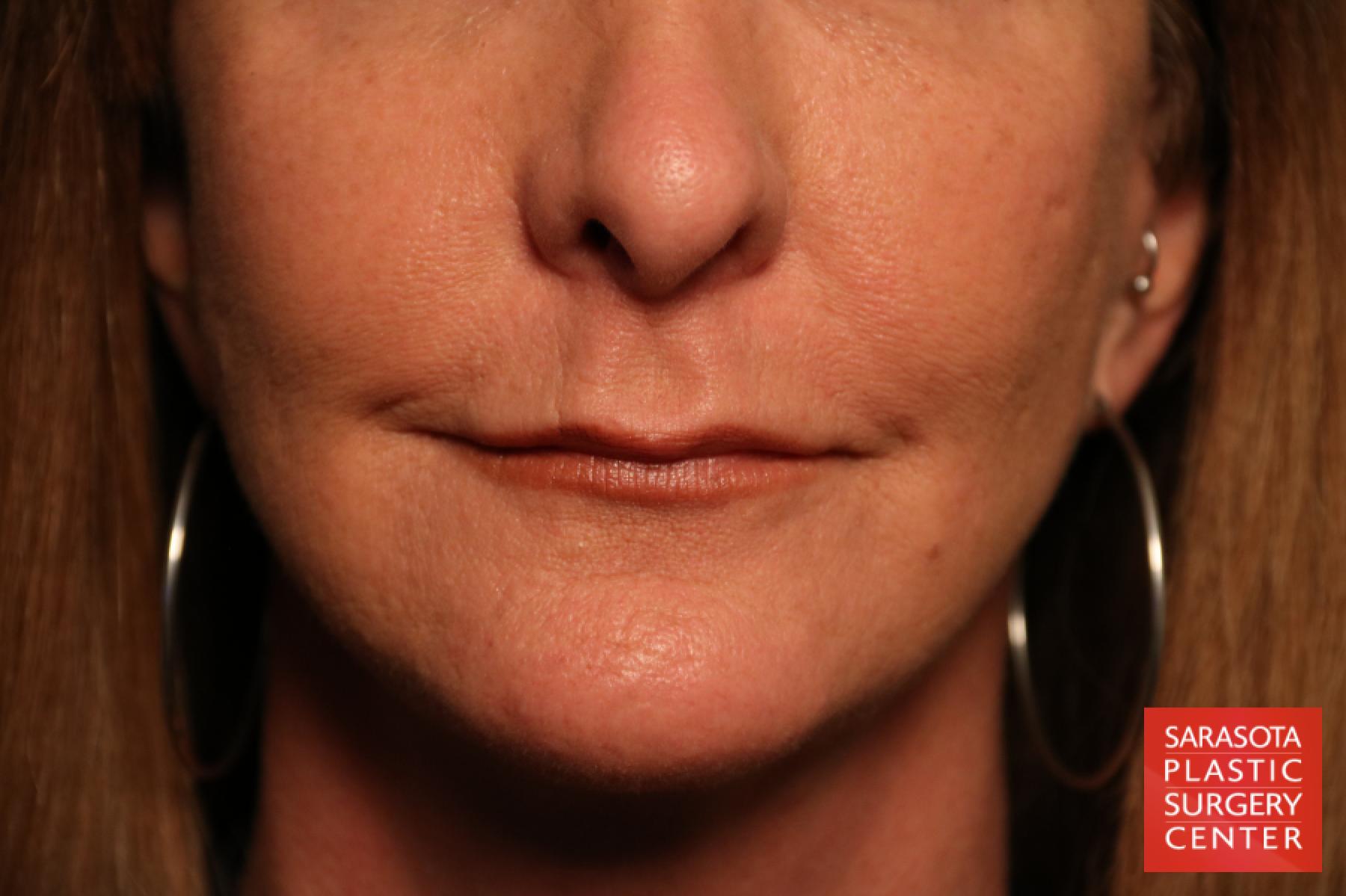 Fillers: Patient 1 - After 1