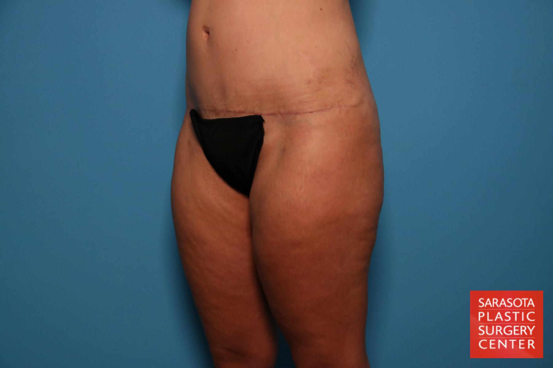 Liposuction: Patient 7 - After 3