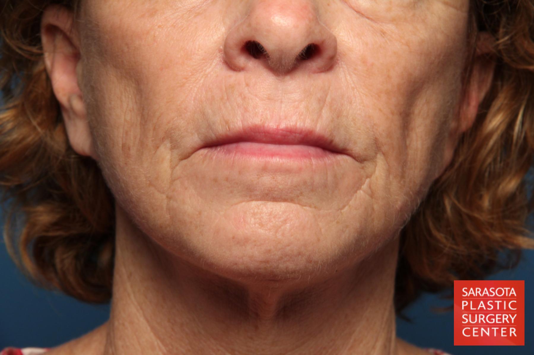 Laser Skin Resurfacing - Face: Patient 12 - Before 1