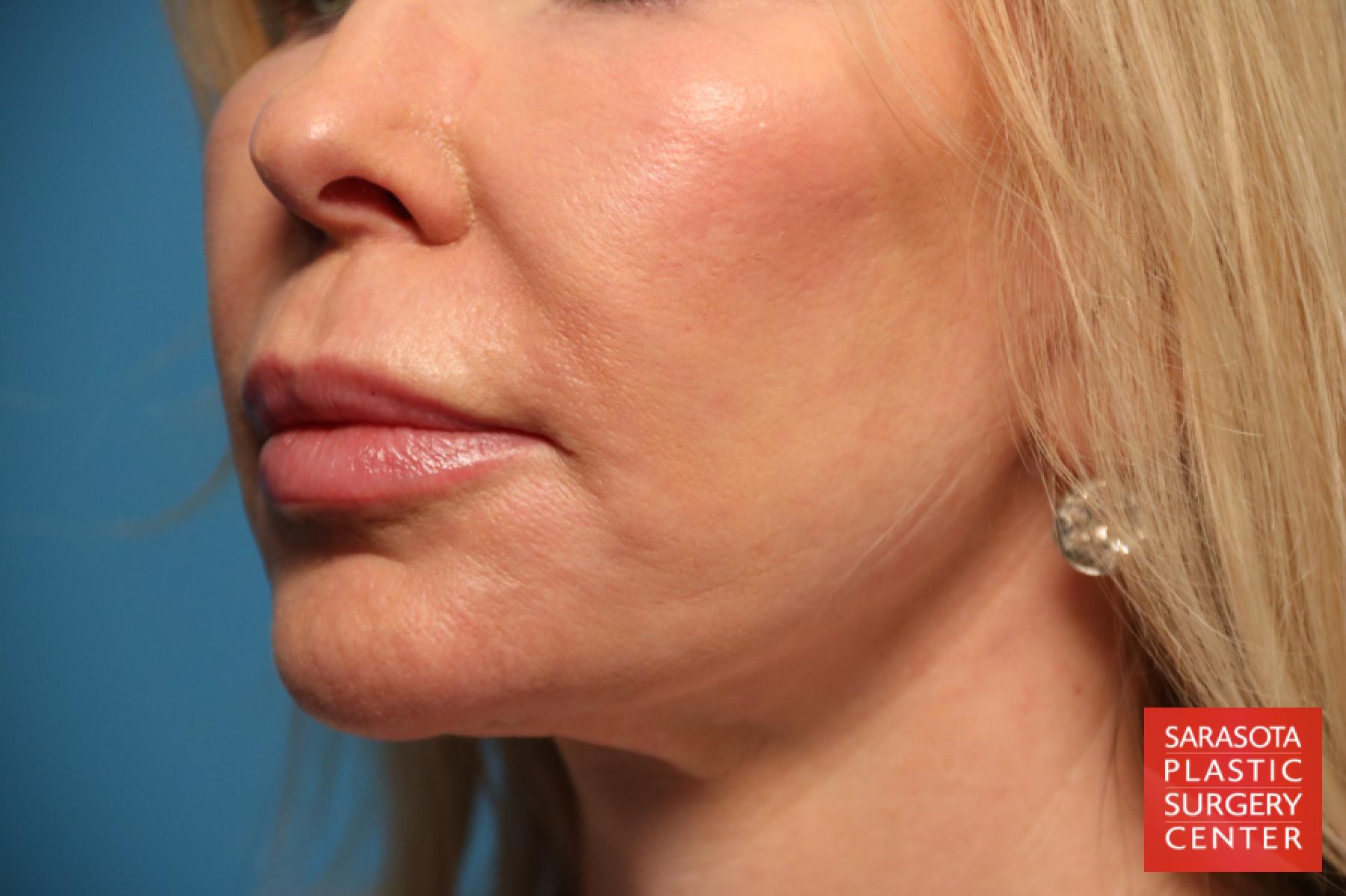 Laser Skin Resurfacing - Face: Patient 7 - After 2