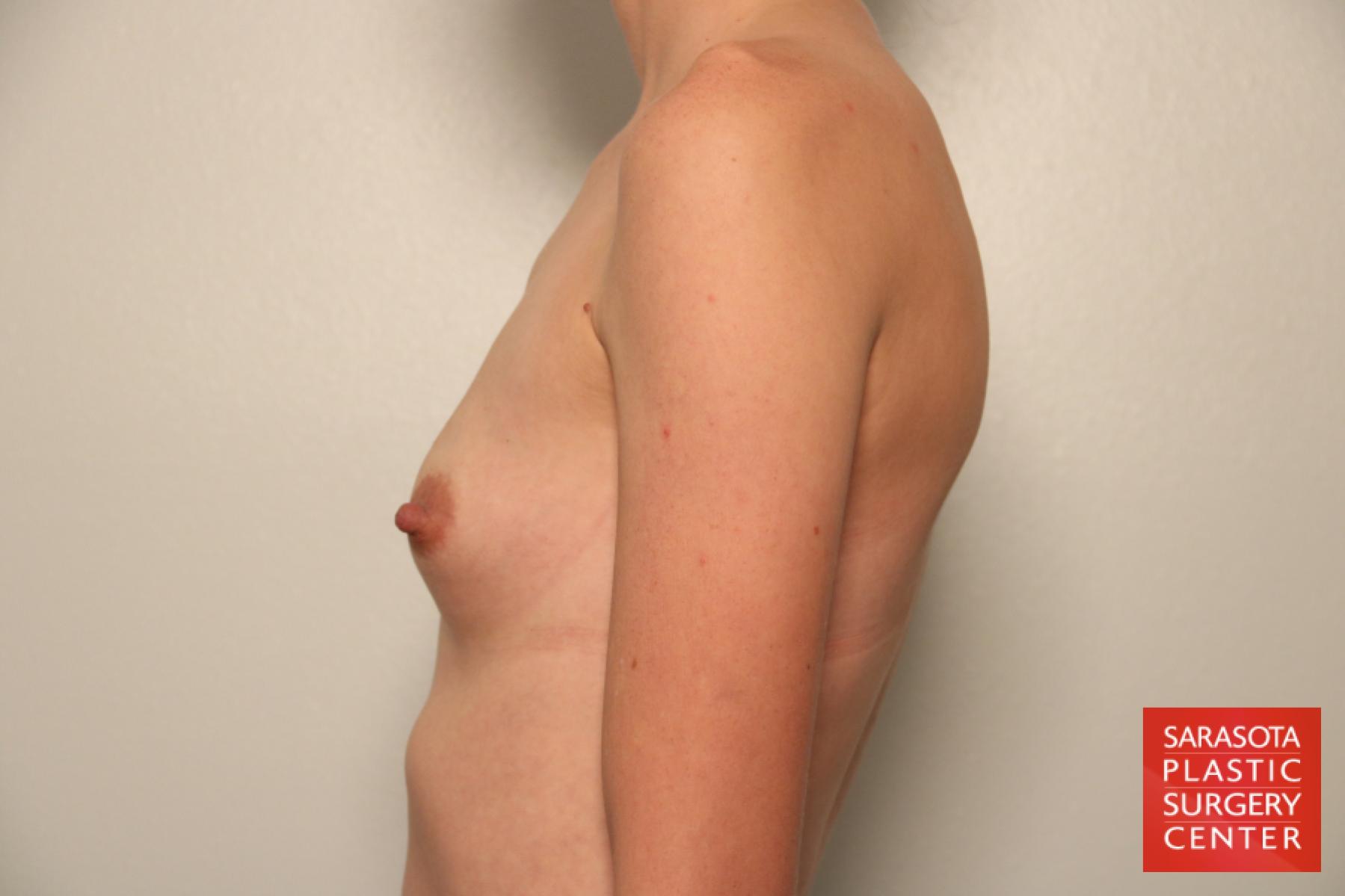Breast Augmentation: Patient 62 - Before and After 3