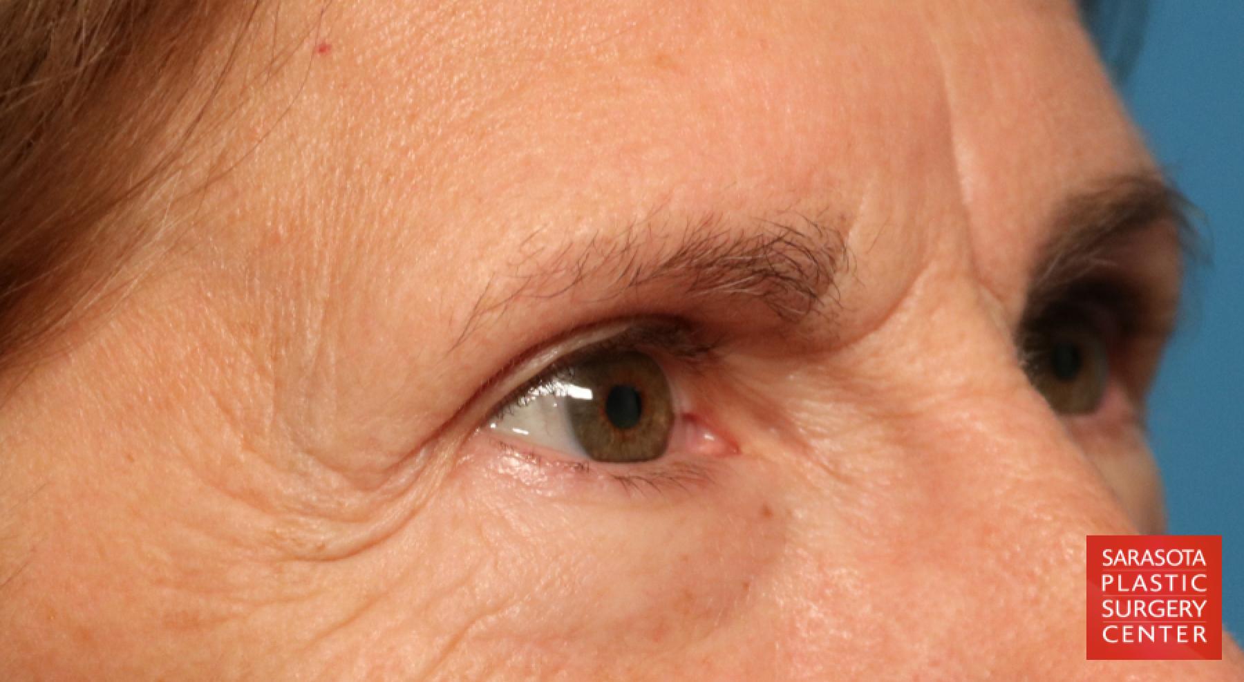 Eyelid Lift: Patient 28 - Before 4