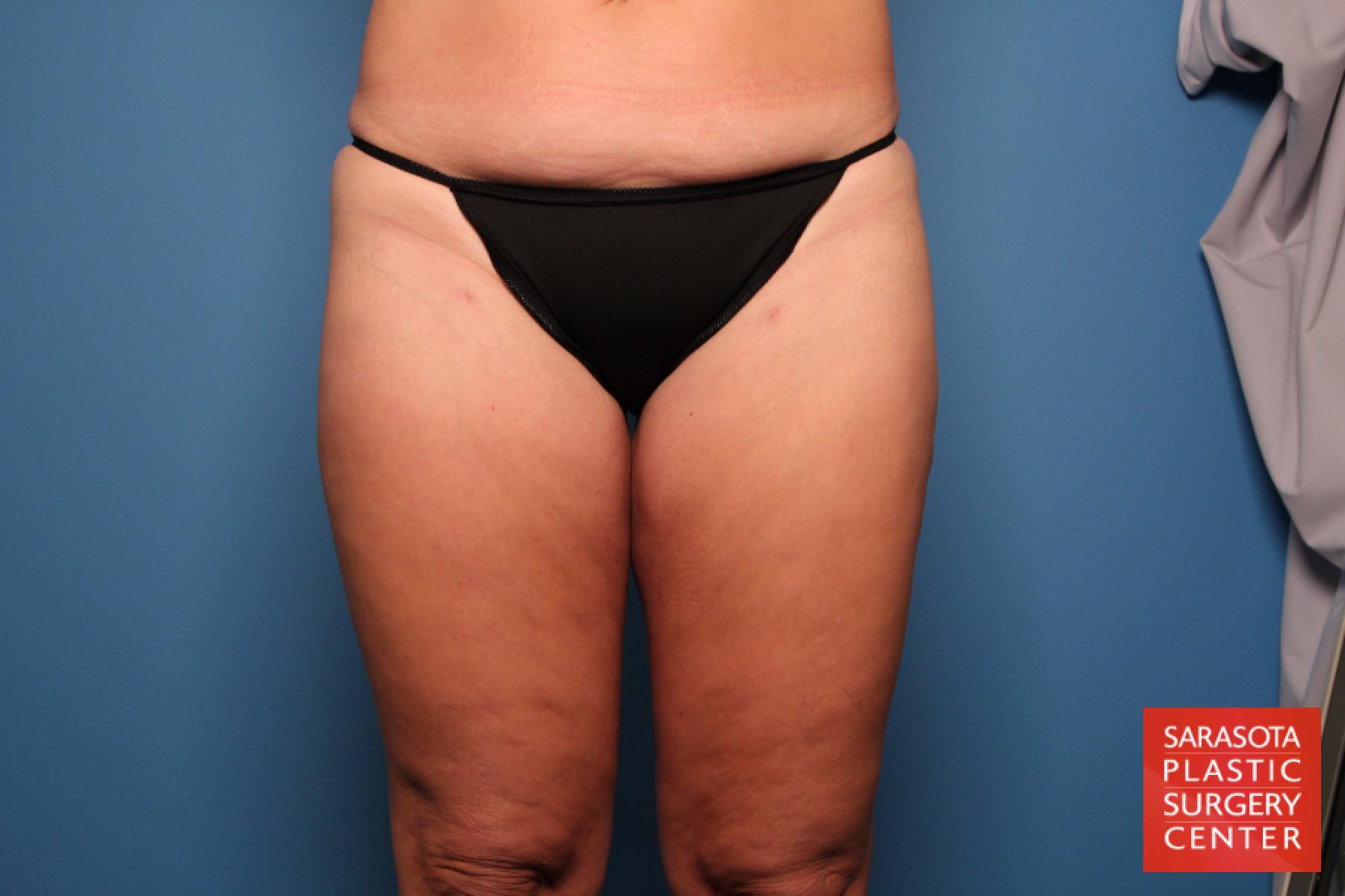 Liposuction: Patient 6 - After 1