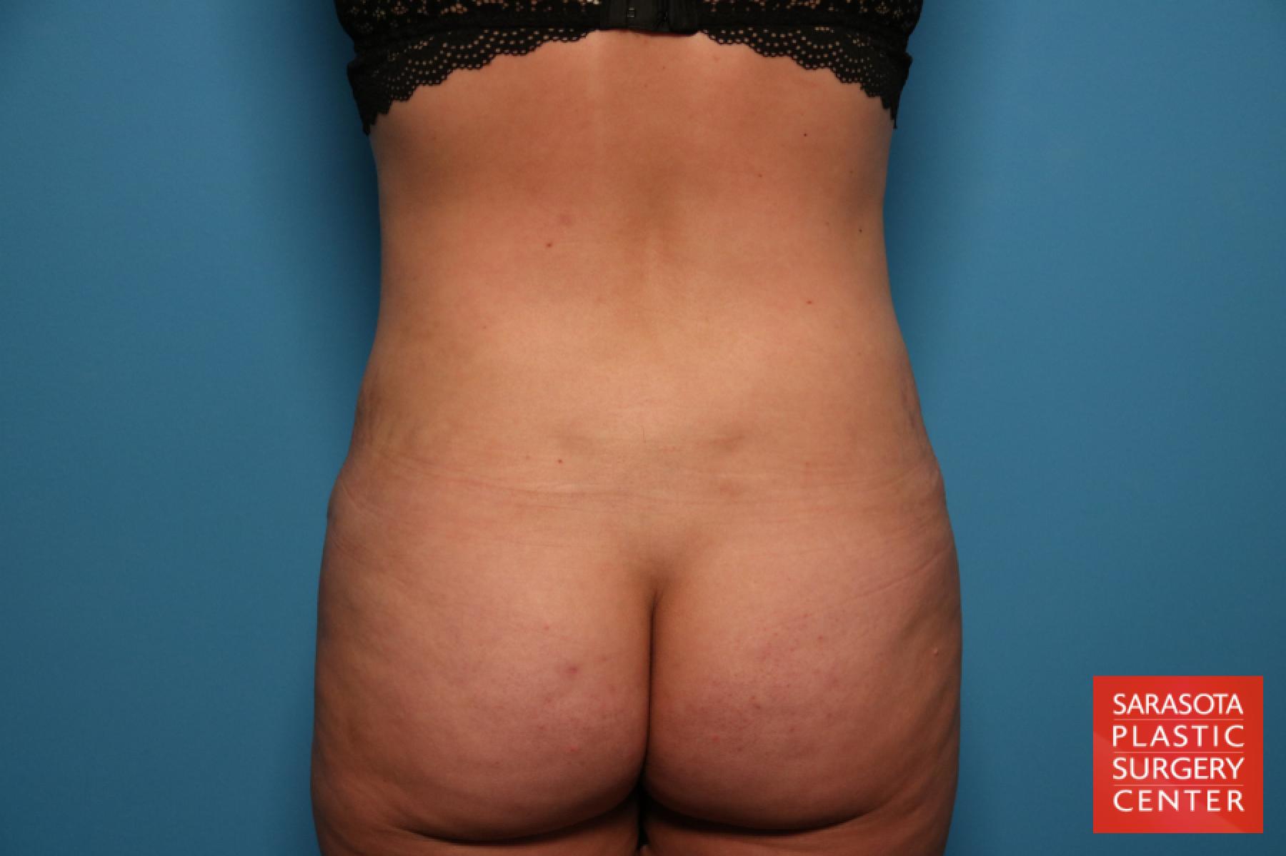 Liposuction: Patient 7 - After 1
