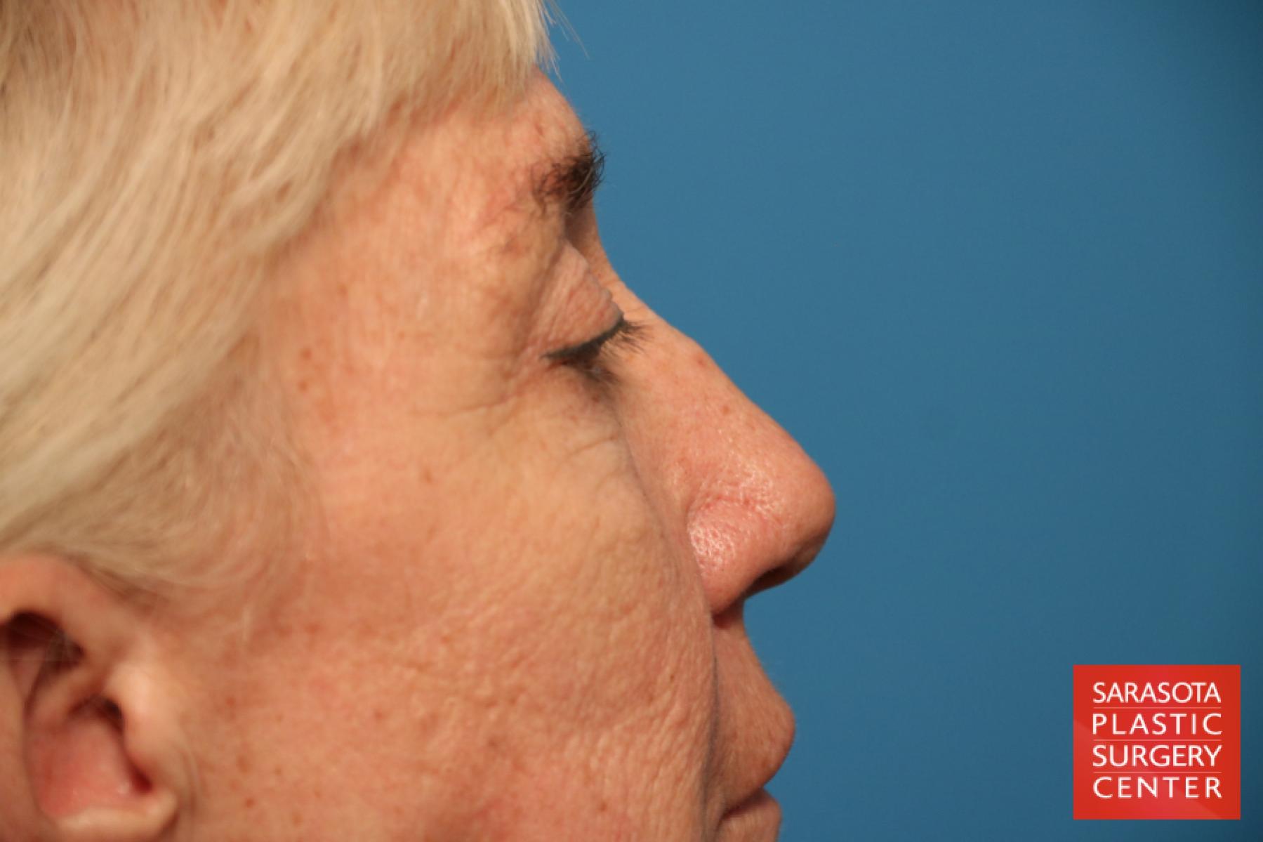 Eyelid Lift: Patient 45 - Before and After 3