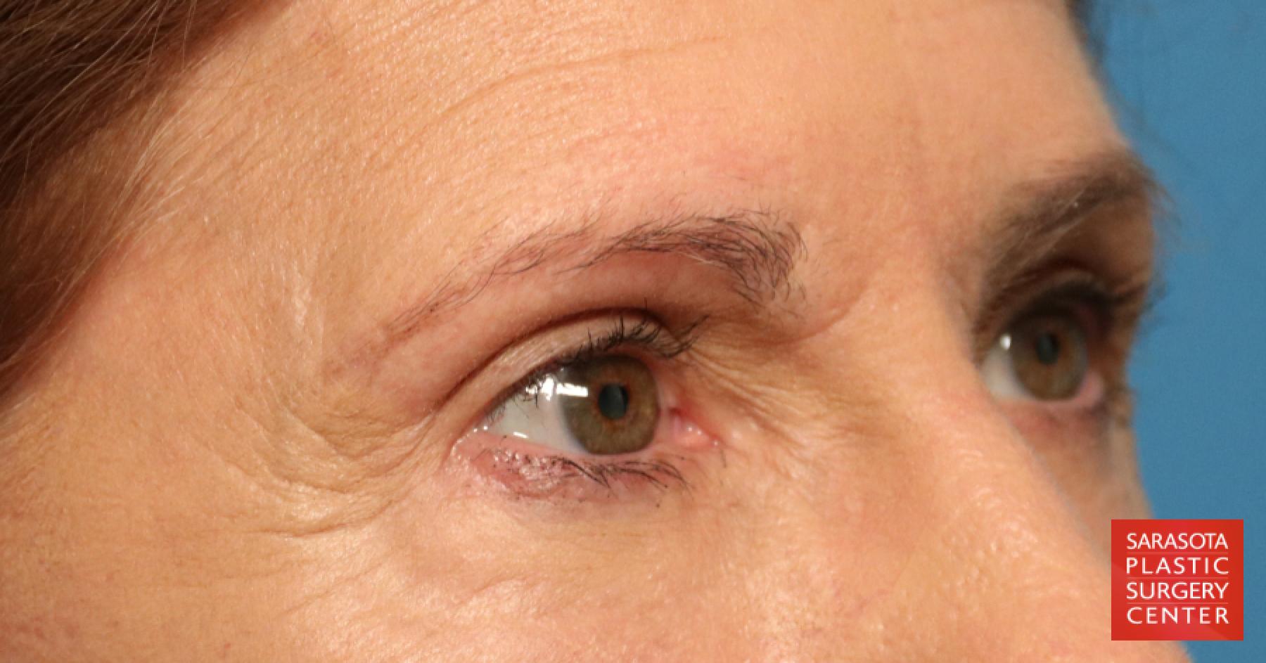 Brow Lift: Patient 1 - After 4
