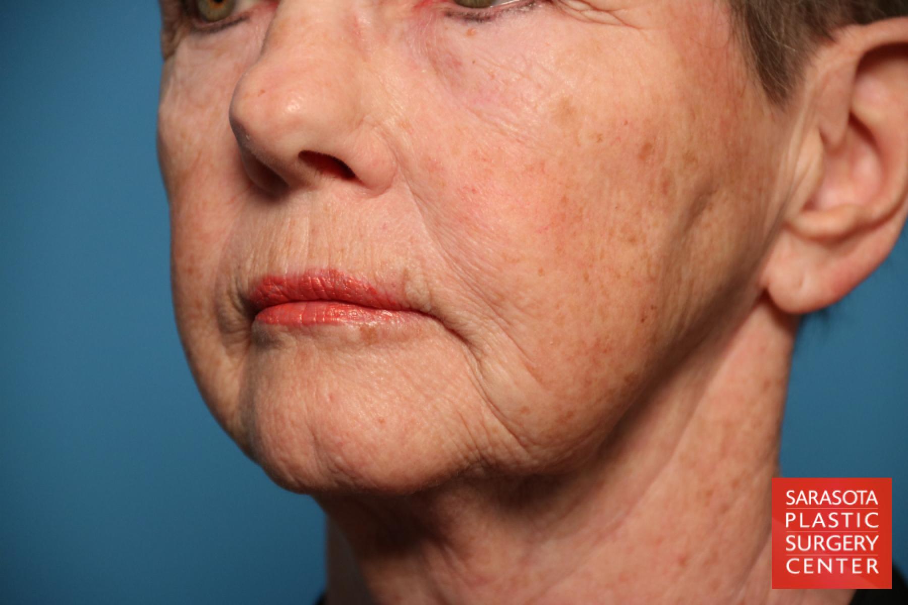 Laser Skin Resurfacing - Face: Patient 14 - Before 2