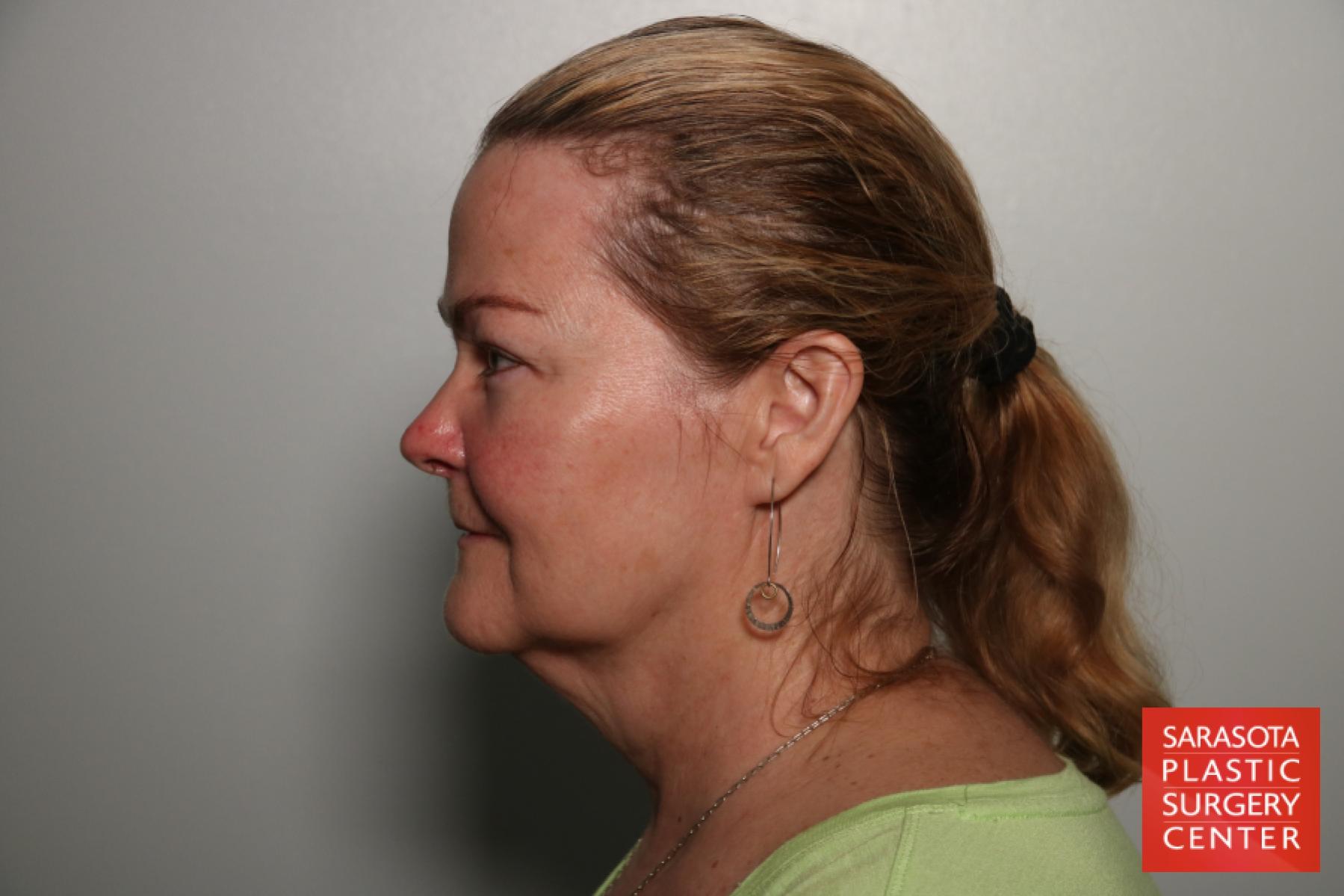 Facelift: Patient 47 - Before and After 3