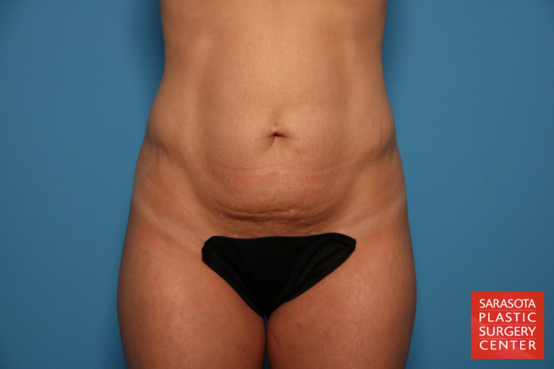 Tummy Tuck: Patient 7 - Before 