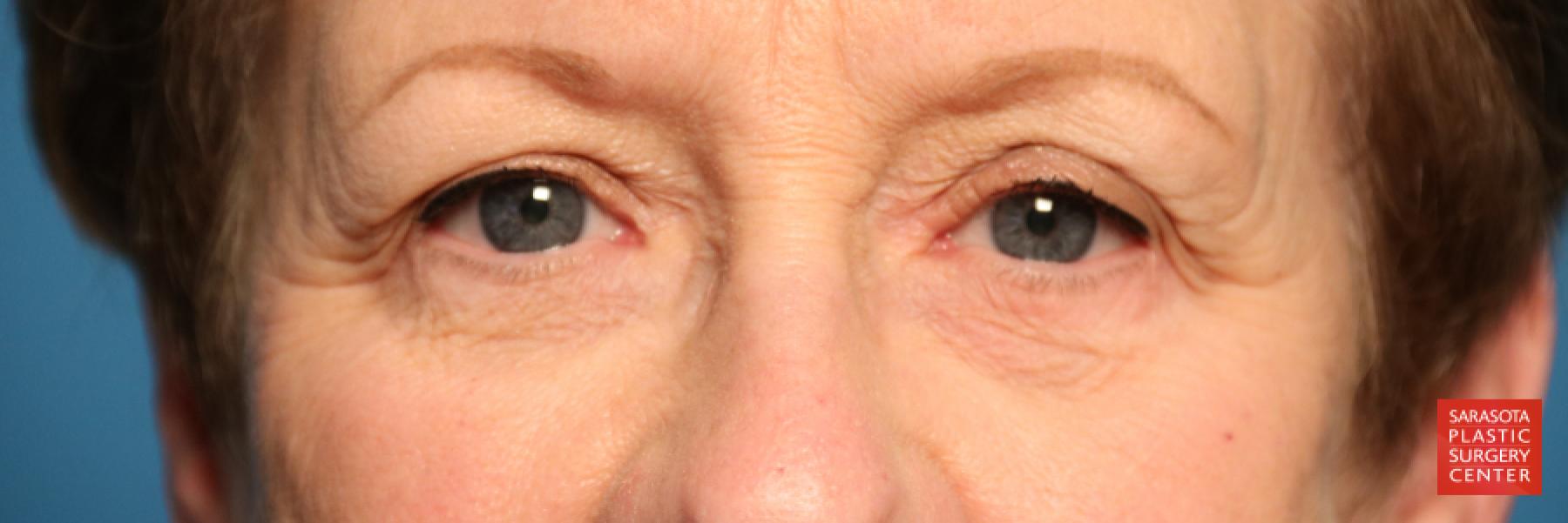 Eyelid Lift: Patient 20 - Before 1