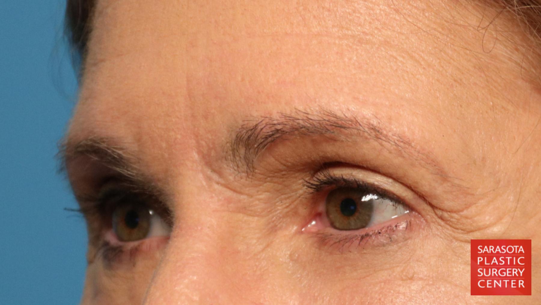 Brow Lift: Patient 1 - After 2