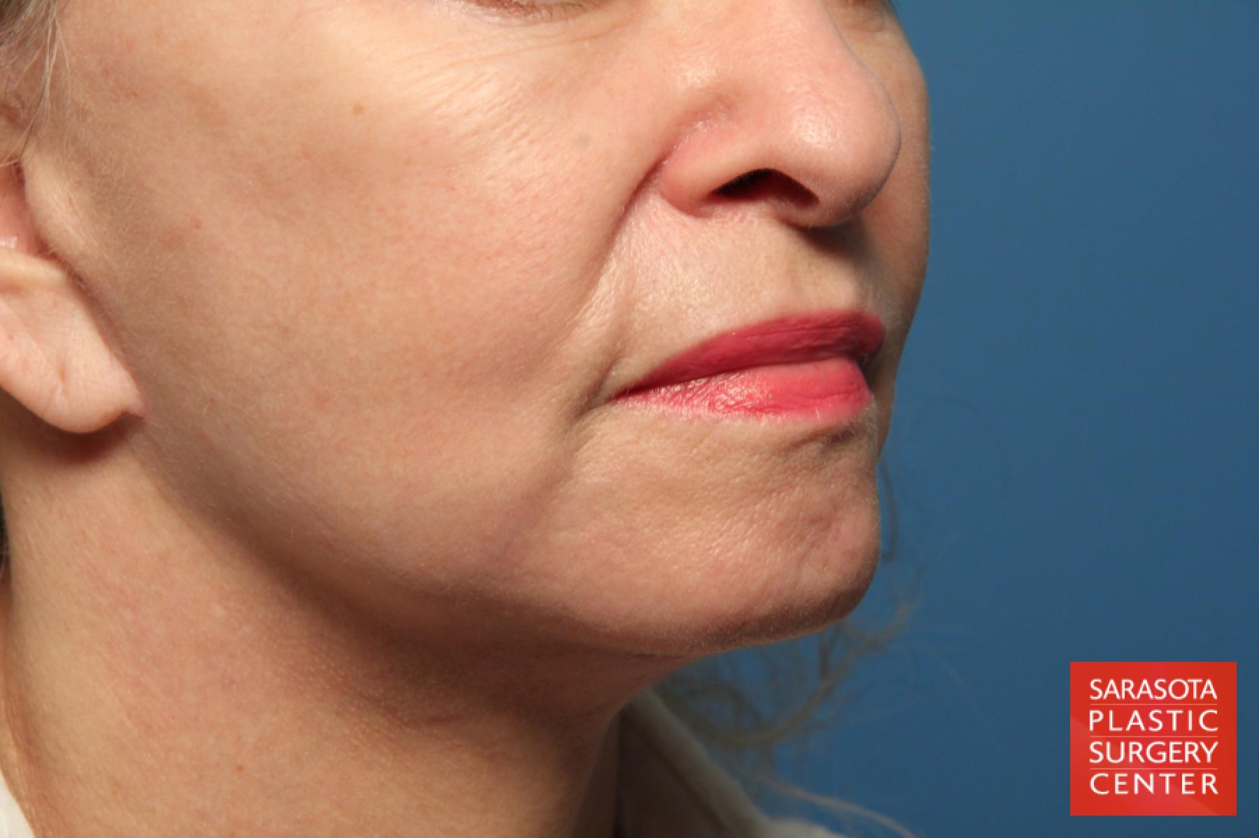 Laser Skin Resurfacing - Face: Patient 1 - After 3