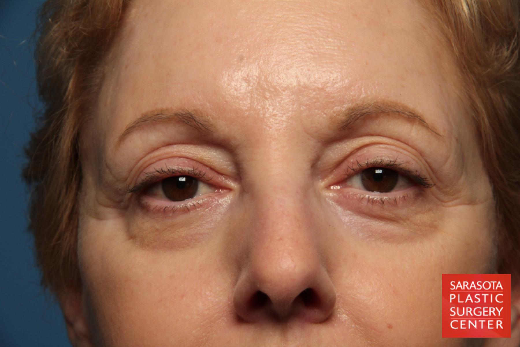 Eyelid Lift: Patient 41 - Before 1