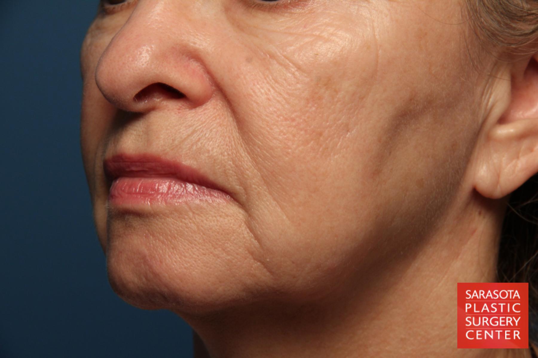 Laser Skin Resurfacing - Face: Patient 1 - Before 2