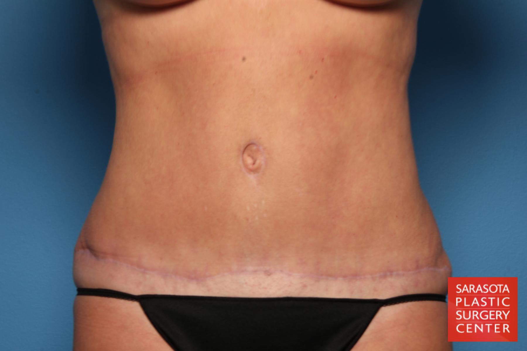 Tummy Tuck: Patient 25 - After 1