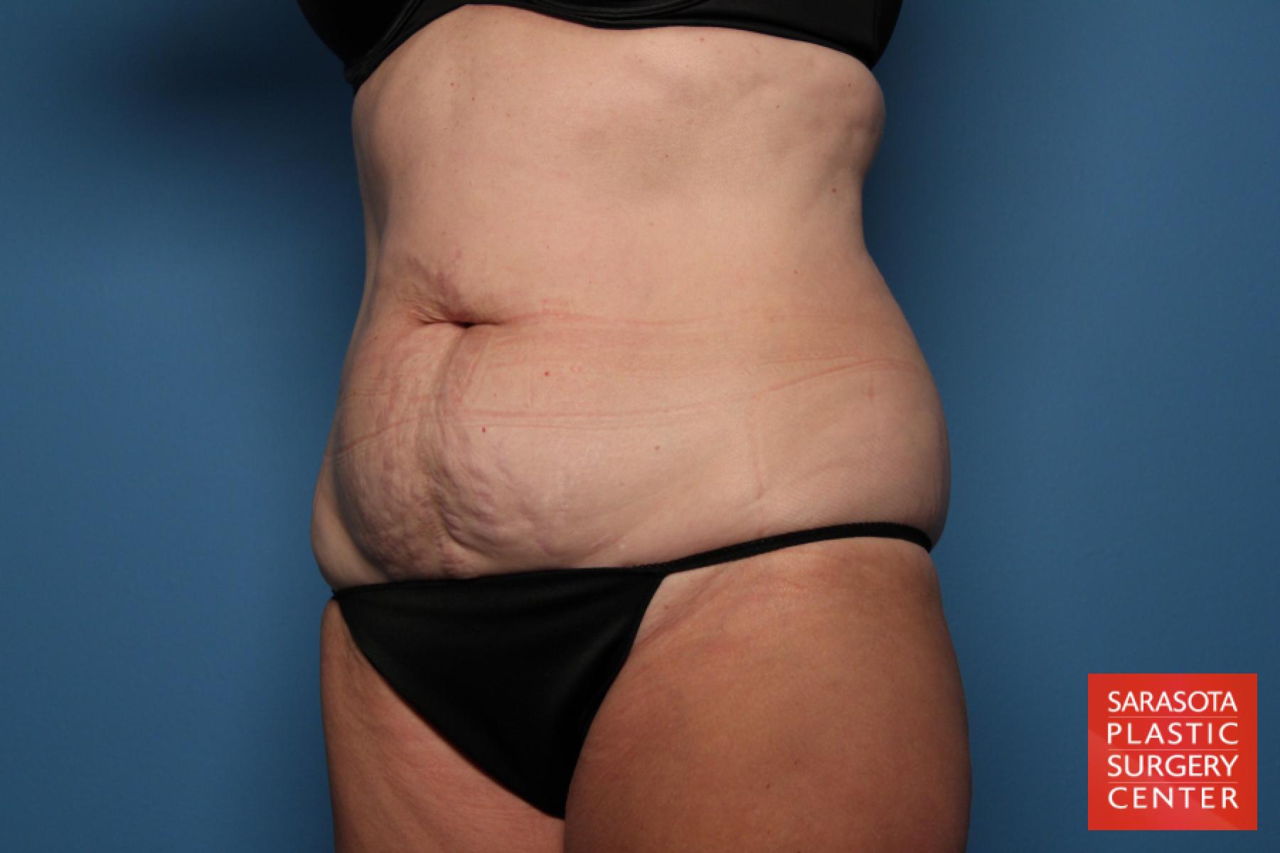 Tummy Tuck: Patient 18 - Before 2