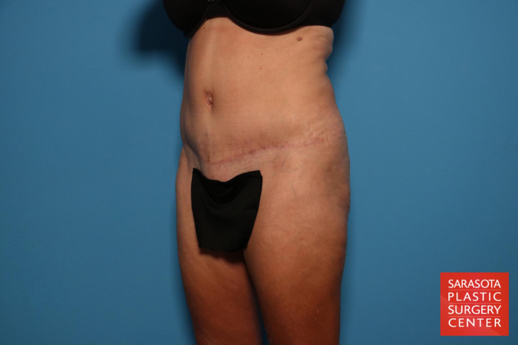 Tummy Tuck: Patient 13 - After 2