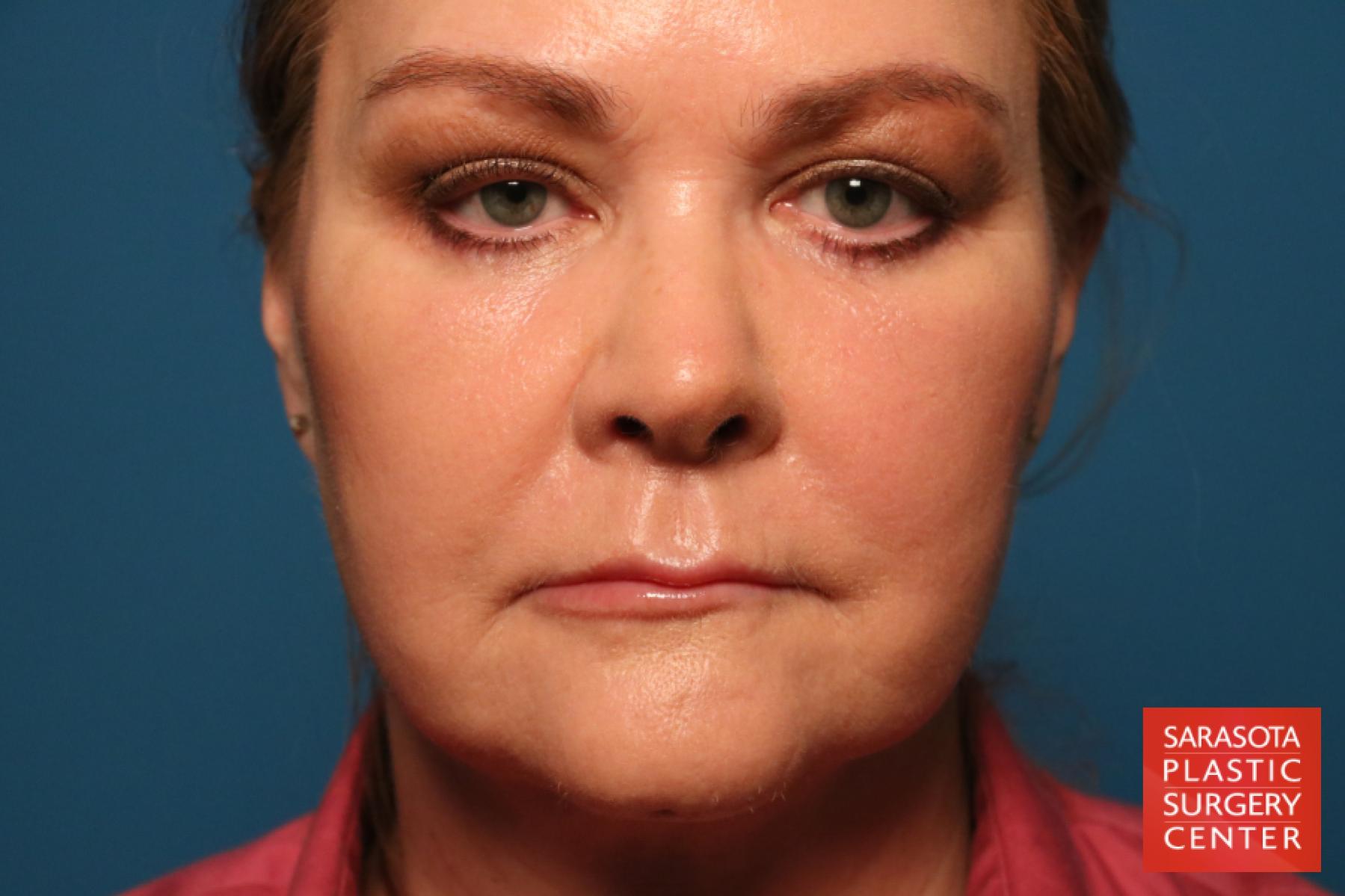Laser Skin Resurfacing - Face: Patient 17 - After 1