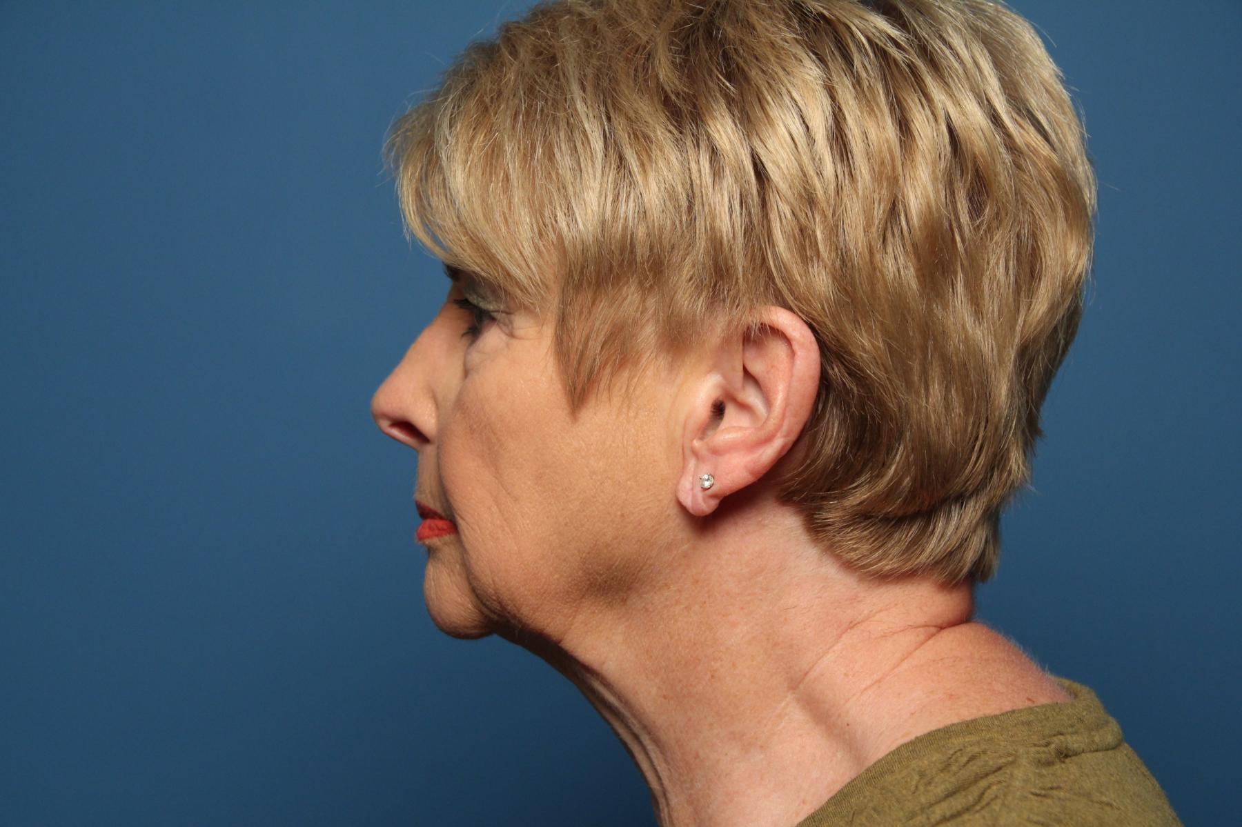 Facelift/Mini Facelift: Patient 2 - Before and After 3