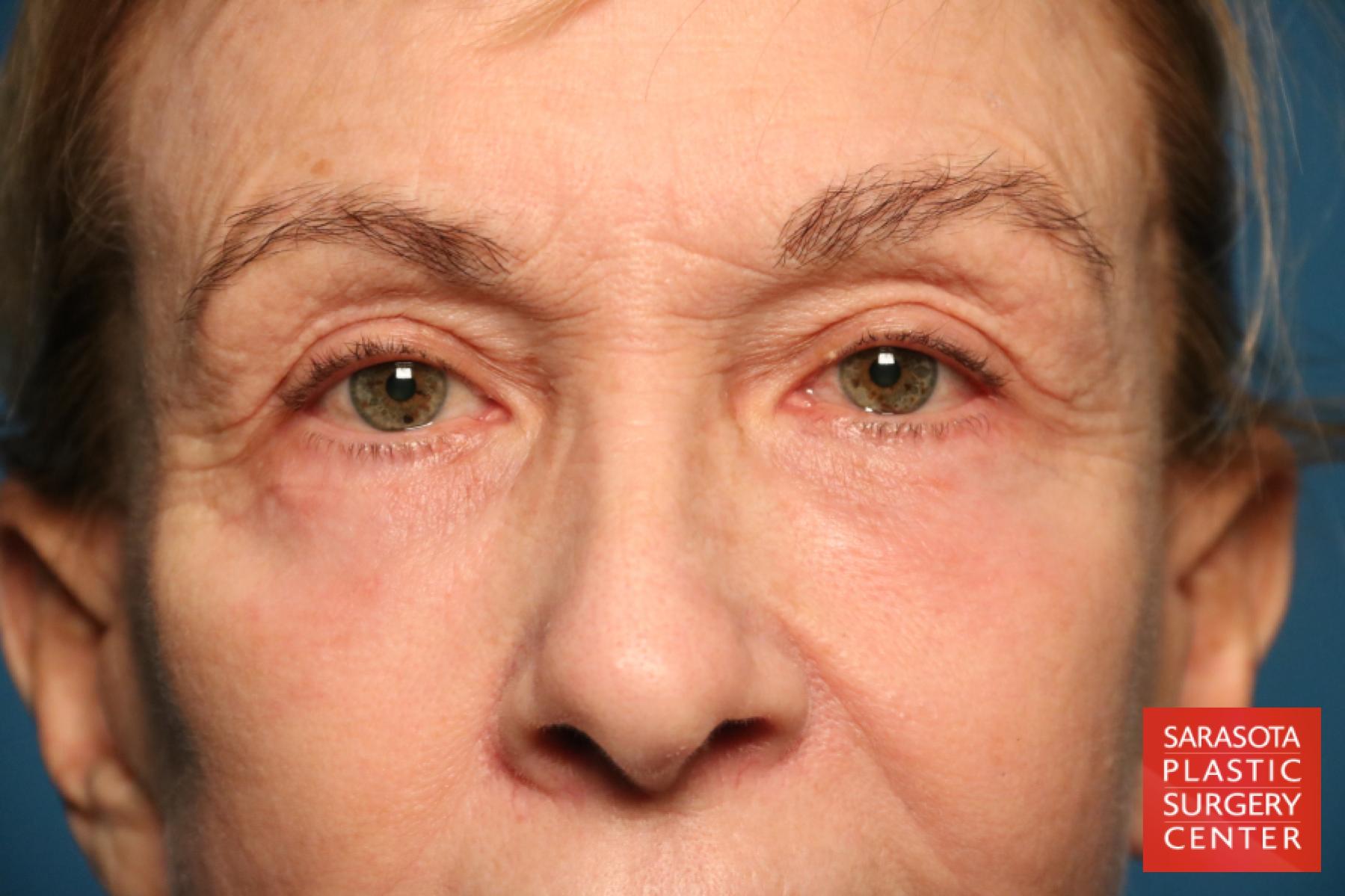 Eyelid Lift: Patient 43 - After 1