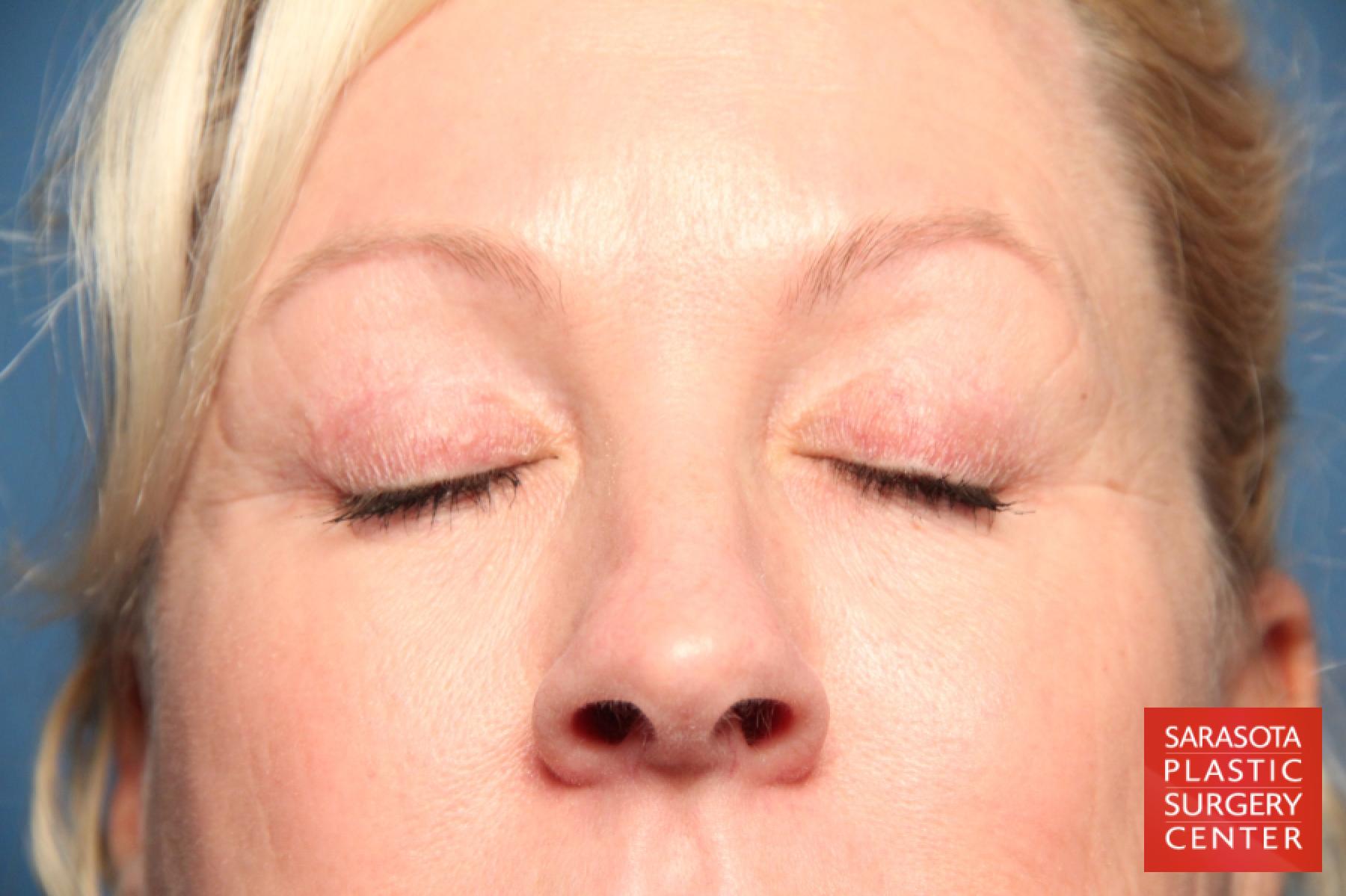 Eyelid Lift: Patient 4 - After 5