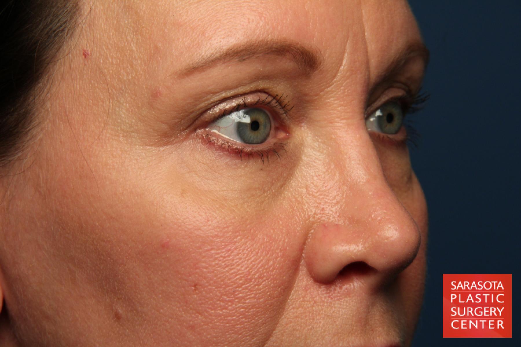 Eyelid Lift: Patient 40 - Before 4