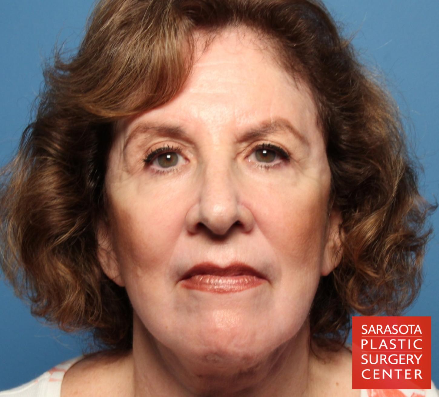 Laser Skin Resurfacing - Face: Patient 6 - After  