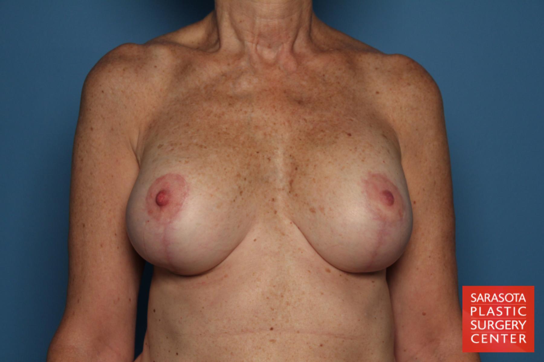 Breast Augmentation With Lift: Patient 28 - After 1