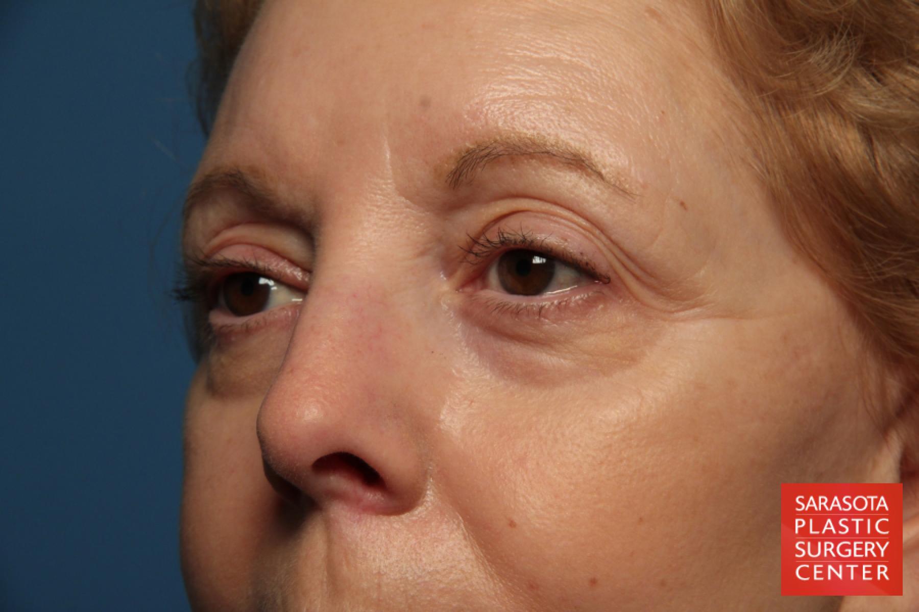 Eyelid Lift: Patient 41 - Before 3
