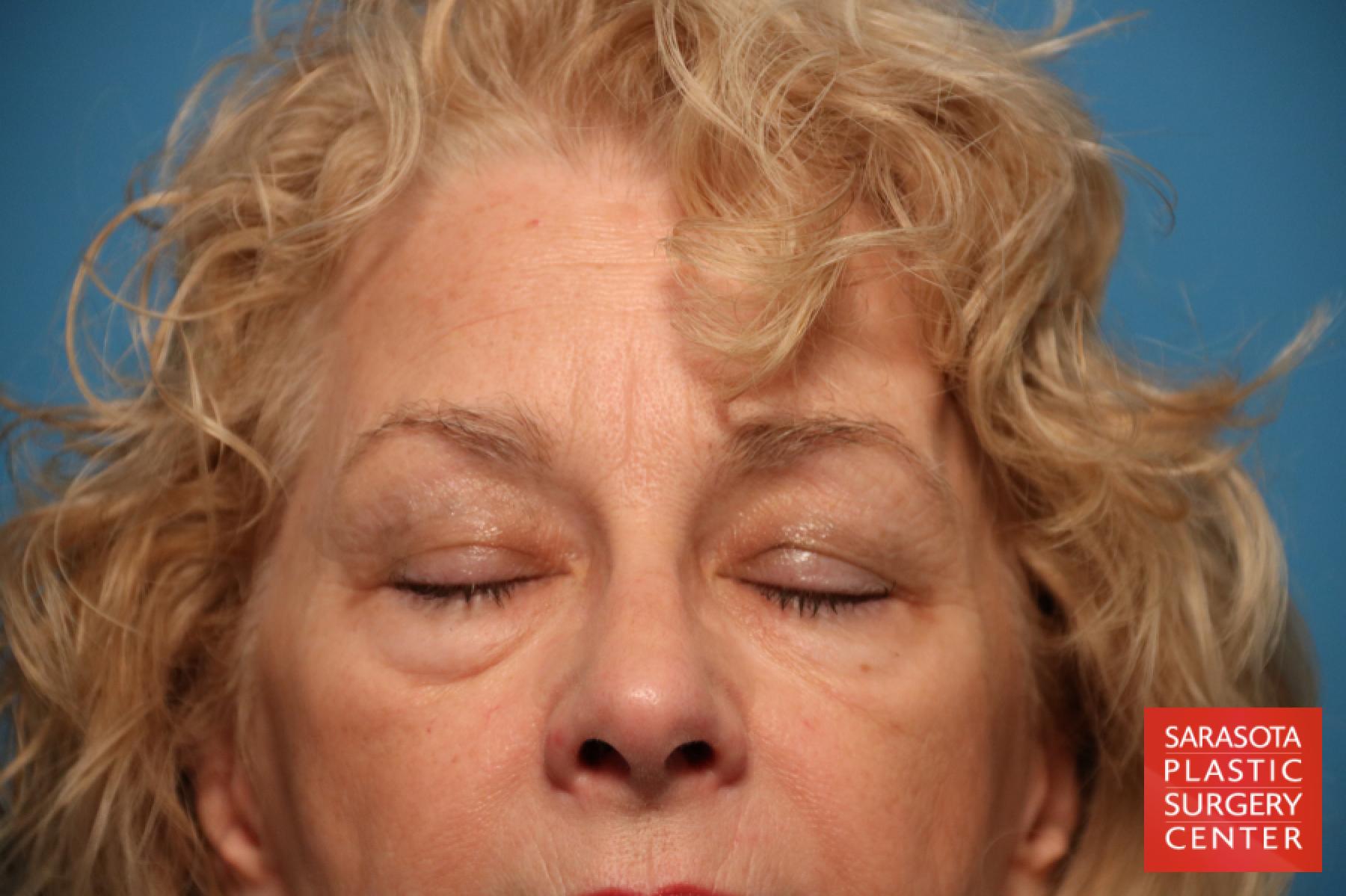 Eyelid Lift: Patient 19 - Before 2