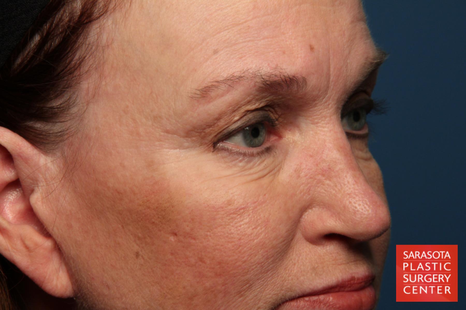 Eyelid Lift: Patient 26 - Before and After 3
