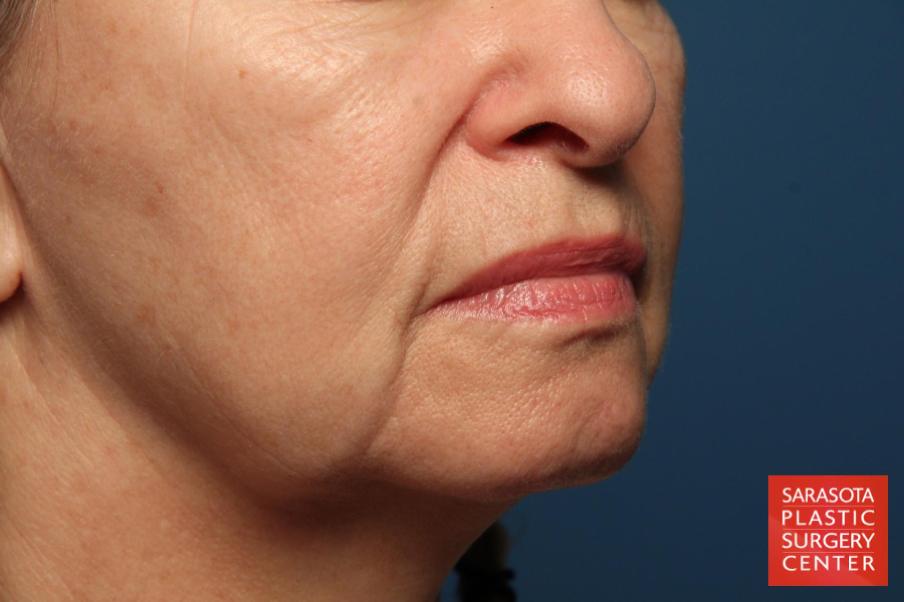 Laser Skin Resurfacing - Face: Patient 1 - Before and After 3