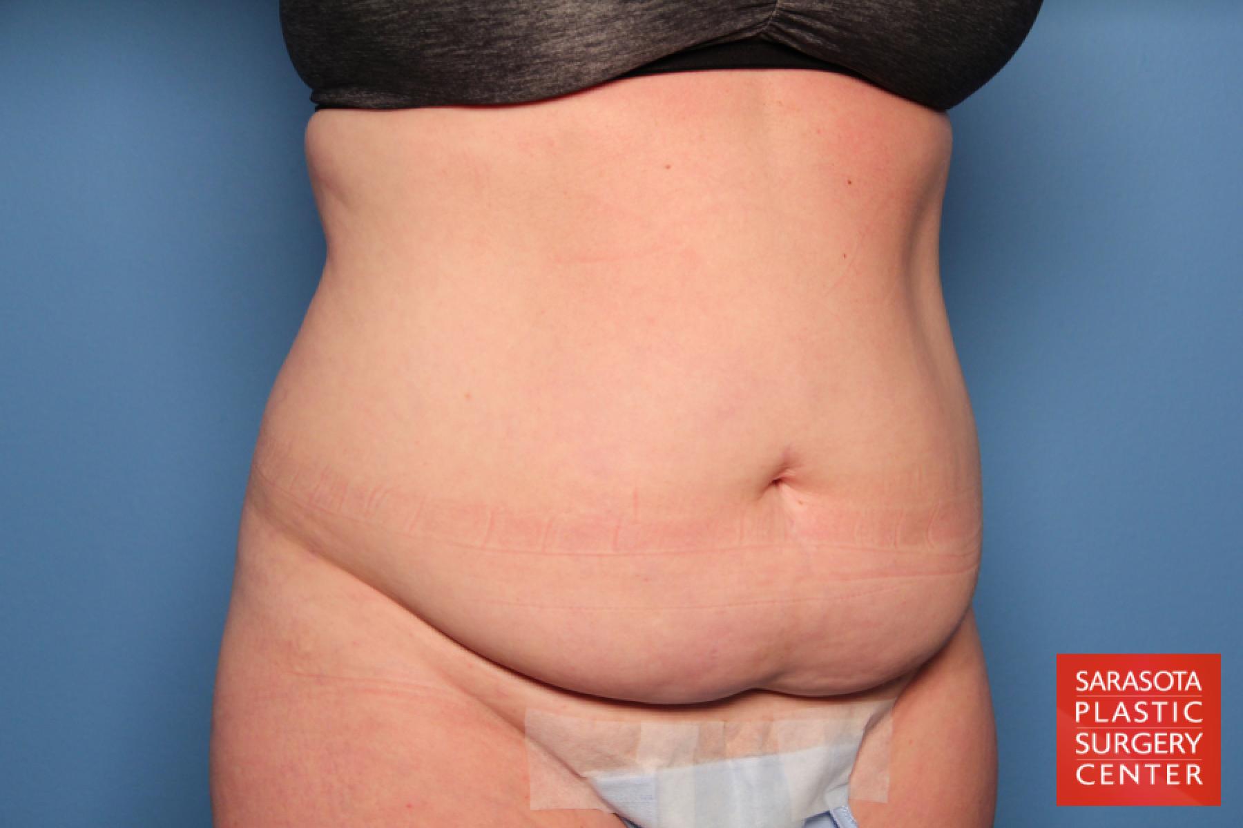 Tummy Tuck: Patient 16 - Before 2
