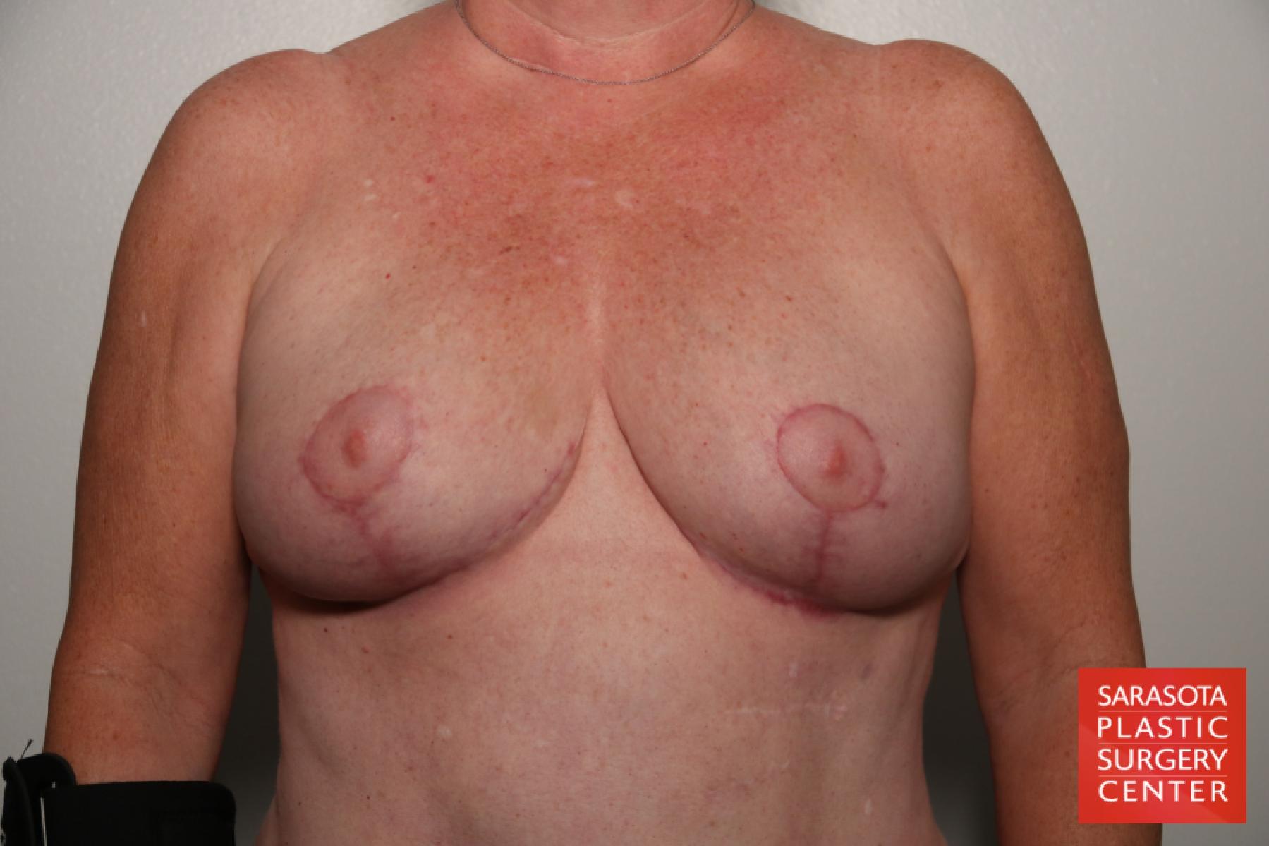 Breast Implant Removal With Lift: Patient 2 - After  