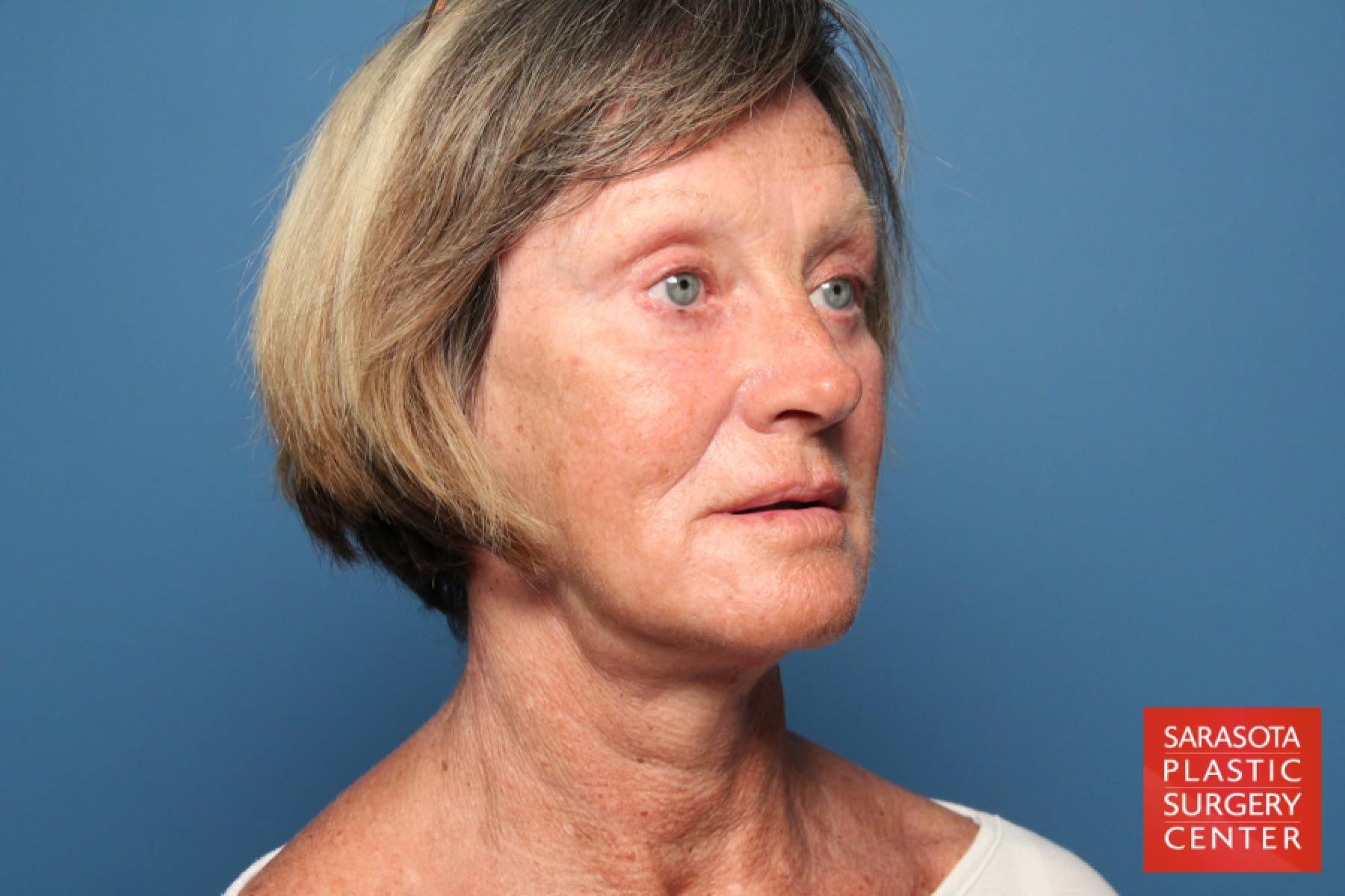 Laser Skin Resurfacing - Face: Patient 11 - After 2