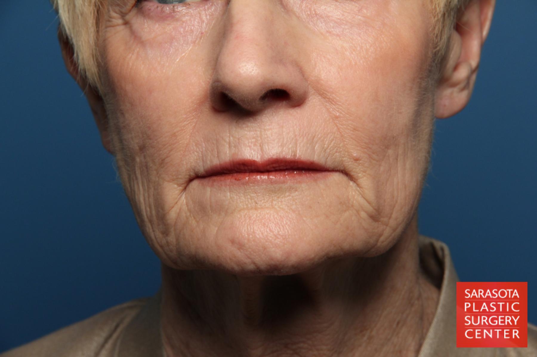 Laser Skin Resurfacing - Face: Patient 15 - Before 1