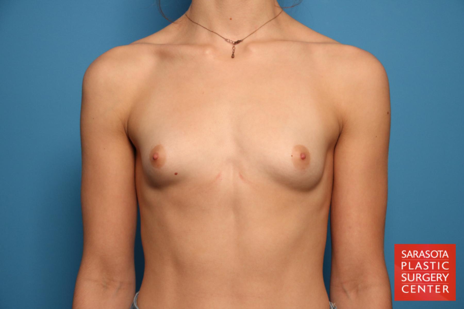 Breast Augmentation: Patient 26 - Before 1