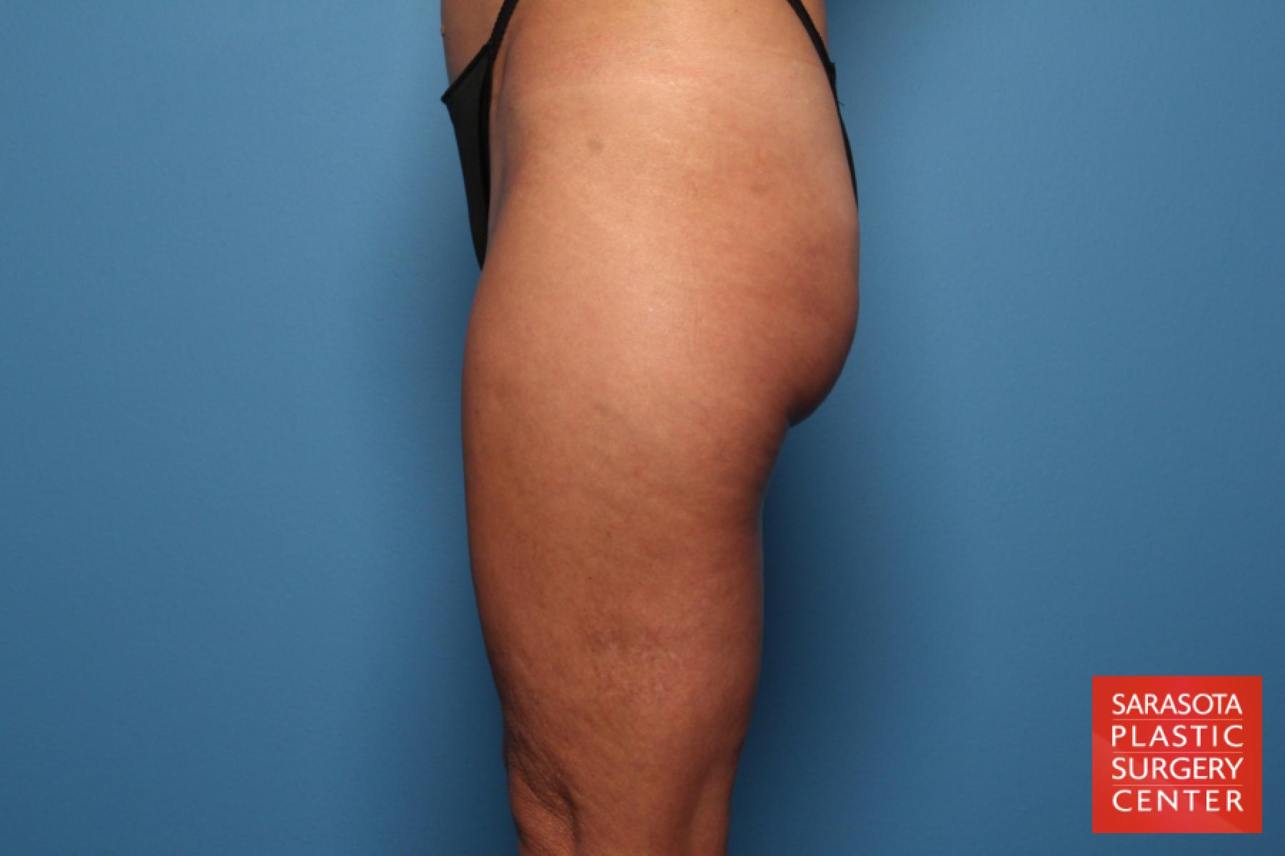 Liposuction: Patient 3 - Before 3