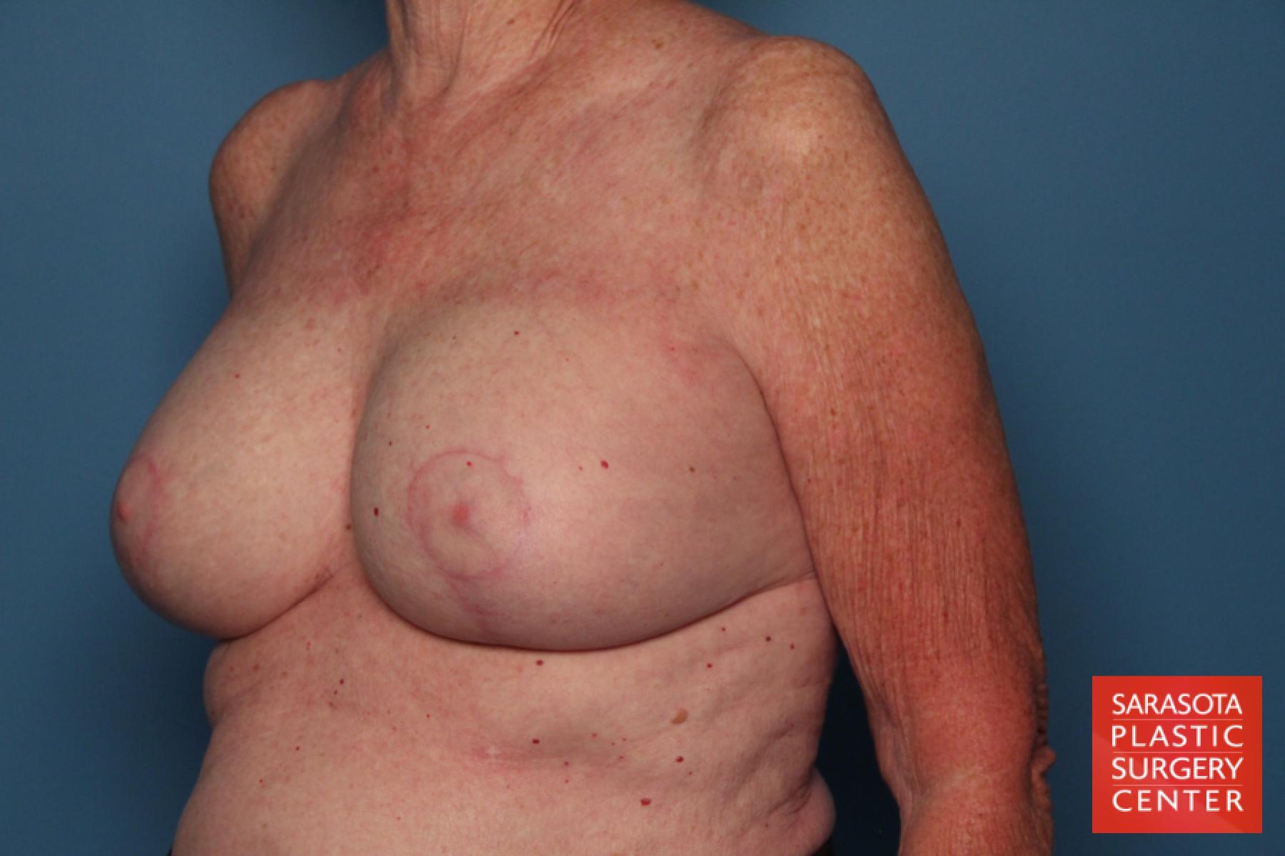 Breast Implant Exchange: Patient 7 - After 2