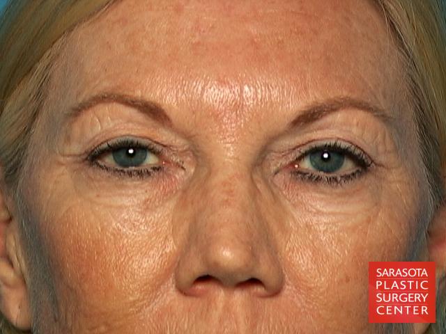 Laser Skin Resurfacing - Face: Patient 2 - Before 