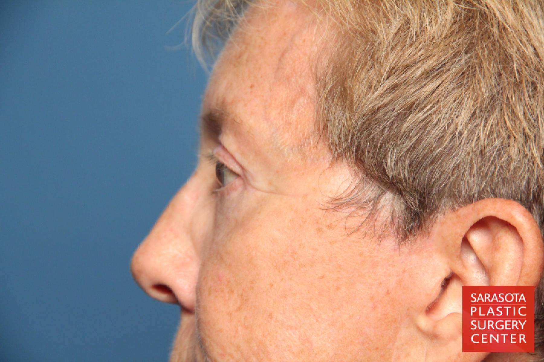 Eyelid Lift: Patient 22 - After 5