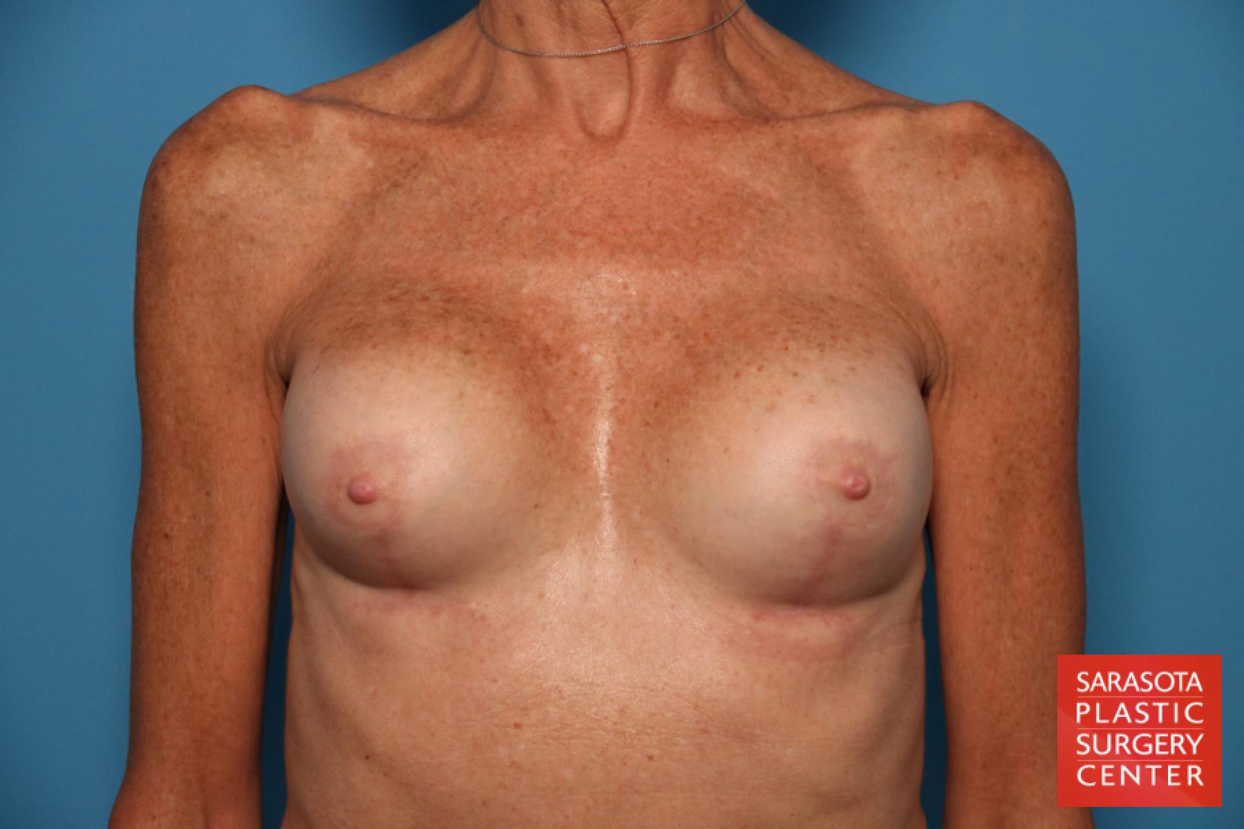 Breast Revision: Patient 7 - After 1