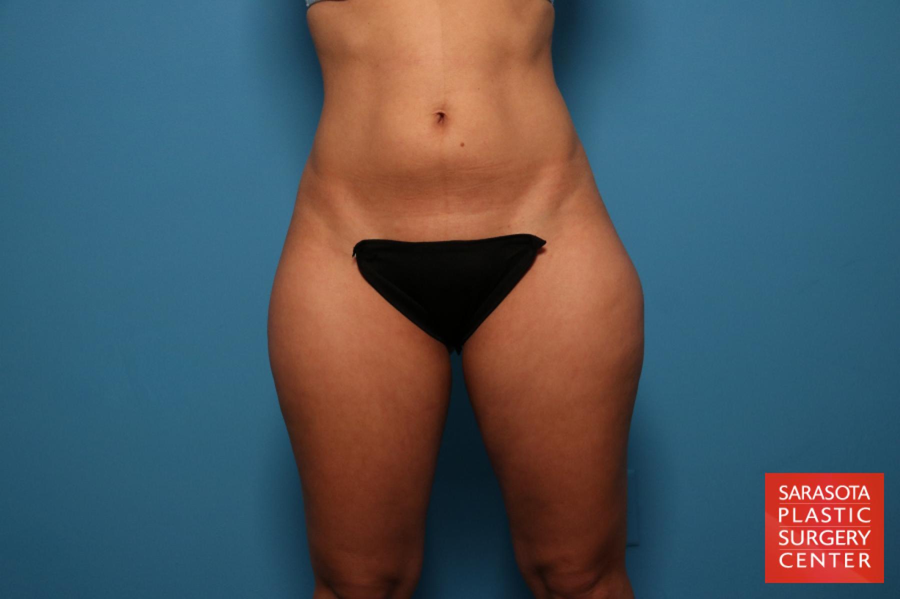 Liposuction: Patient 13 - Before 1