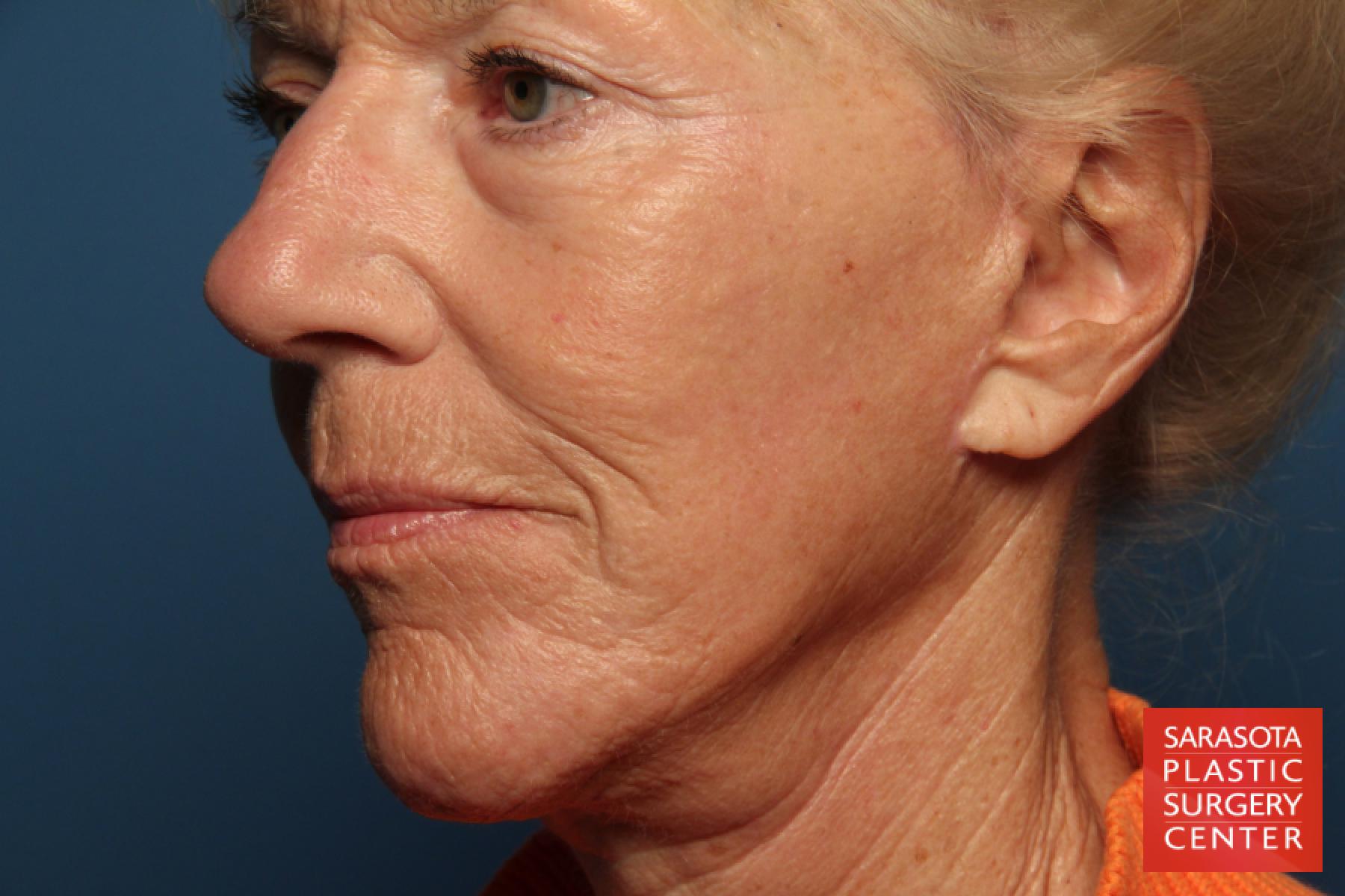 Laser Skin Resurfacing - Face: Patient 8 - After 2