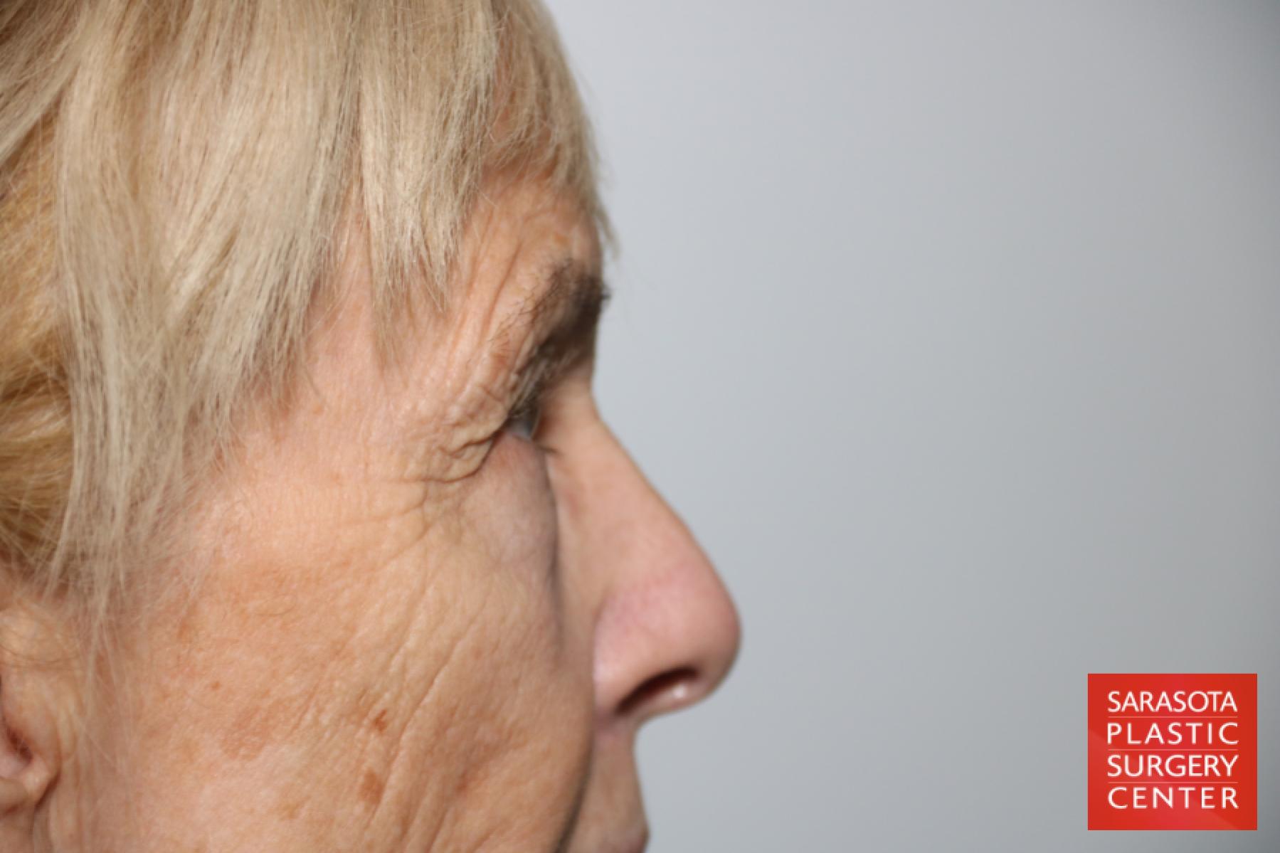 Eyelid Lift: Patient 43 - Before and After 4