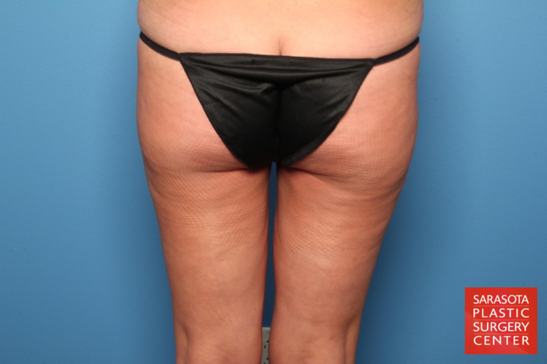 Liposuction: Patient 12 - After 2
