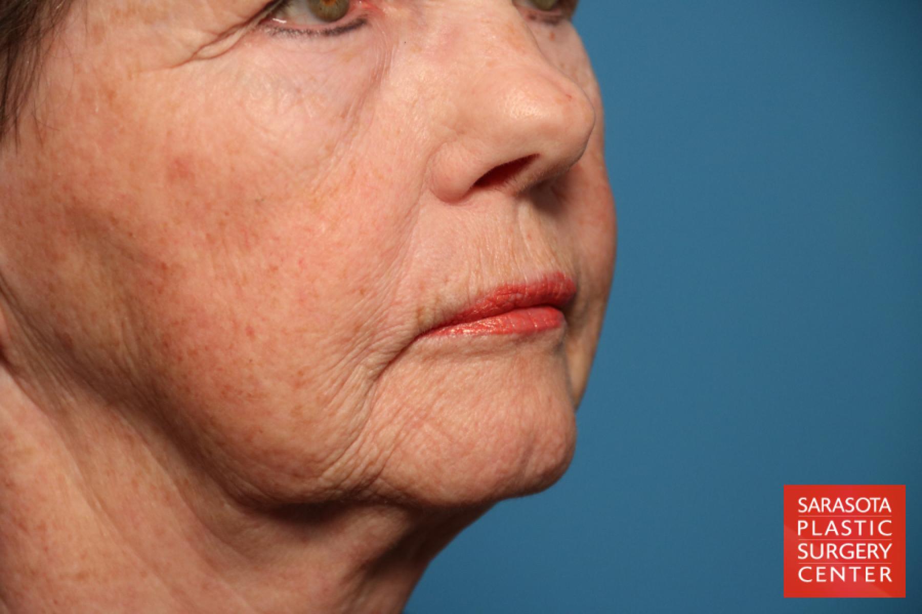 Laser Skin Resurfacing - Face: Patient 14 - Before and After 3