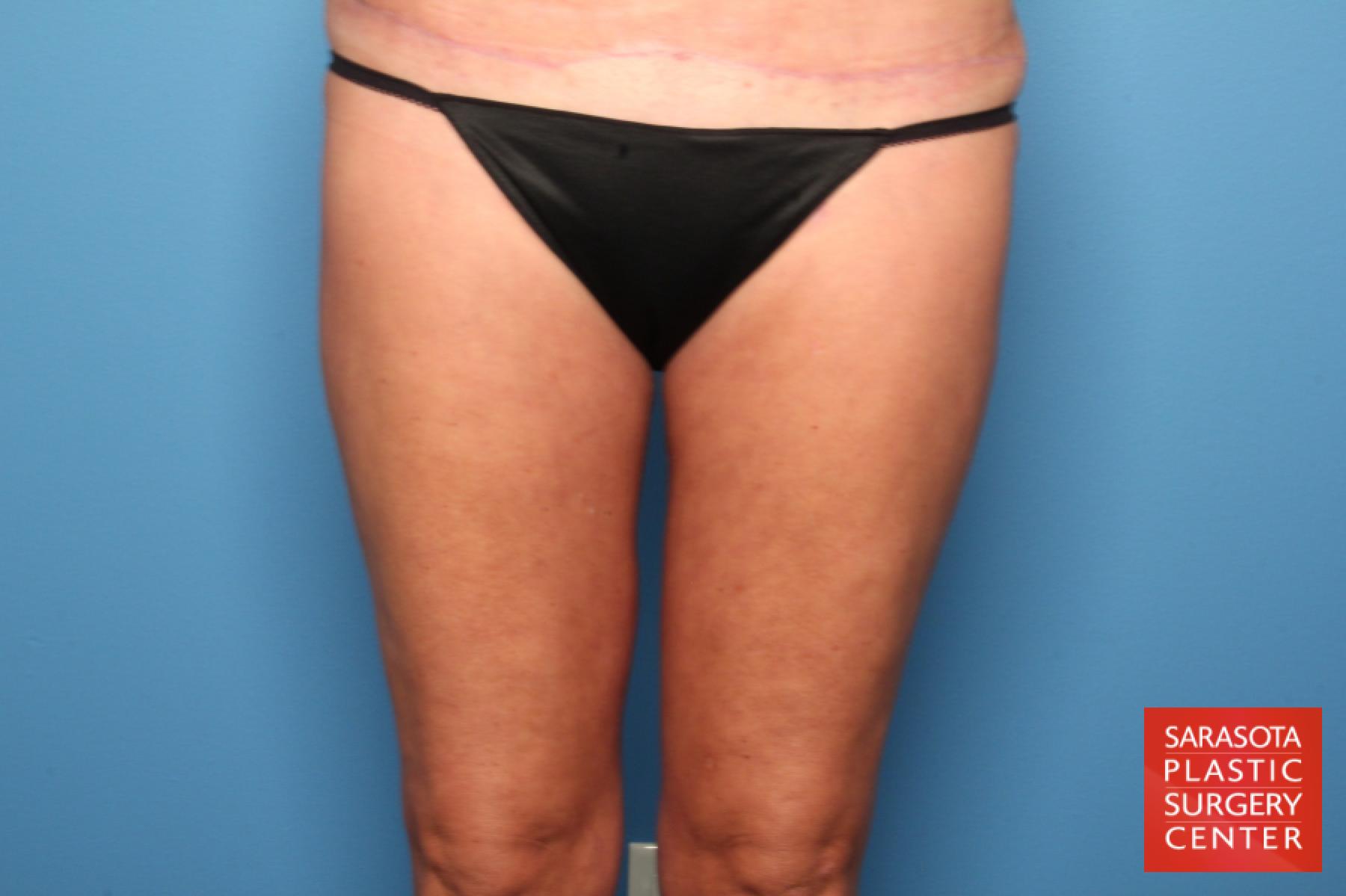 Liposuction: Patient 12 - After 1