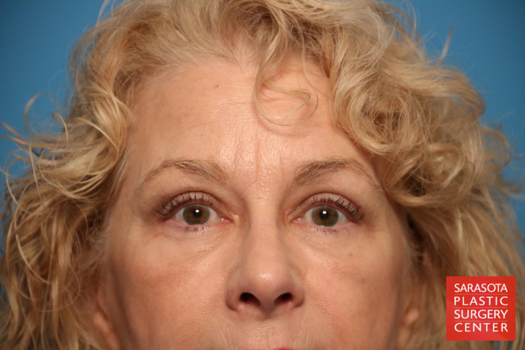 Eyelid Lift: Patient 19 - After 1