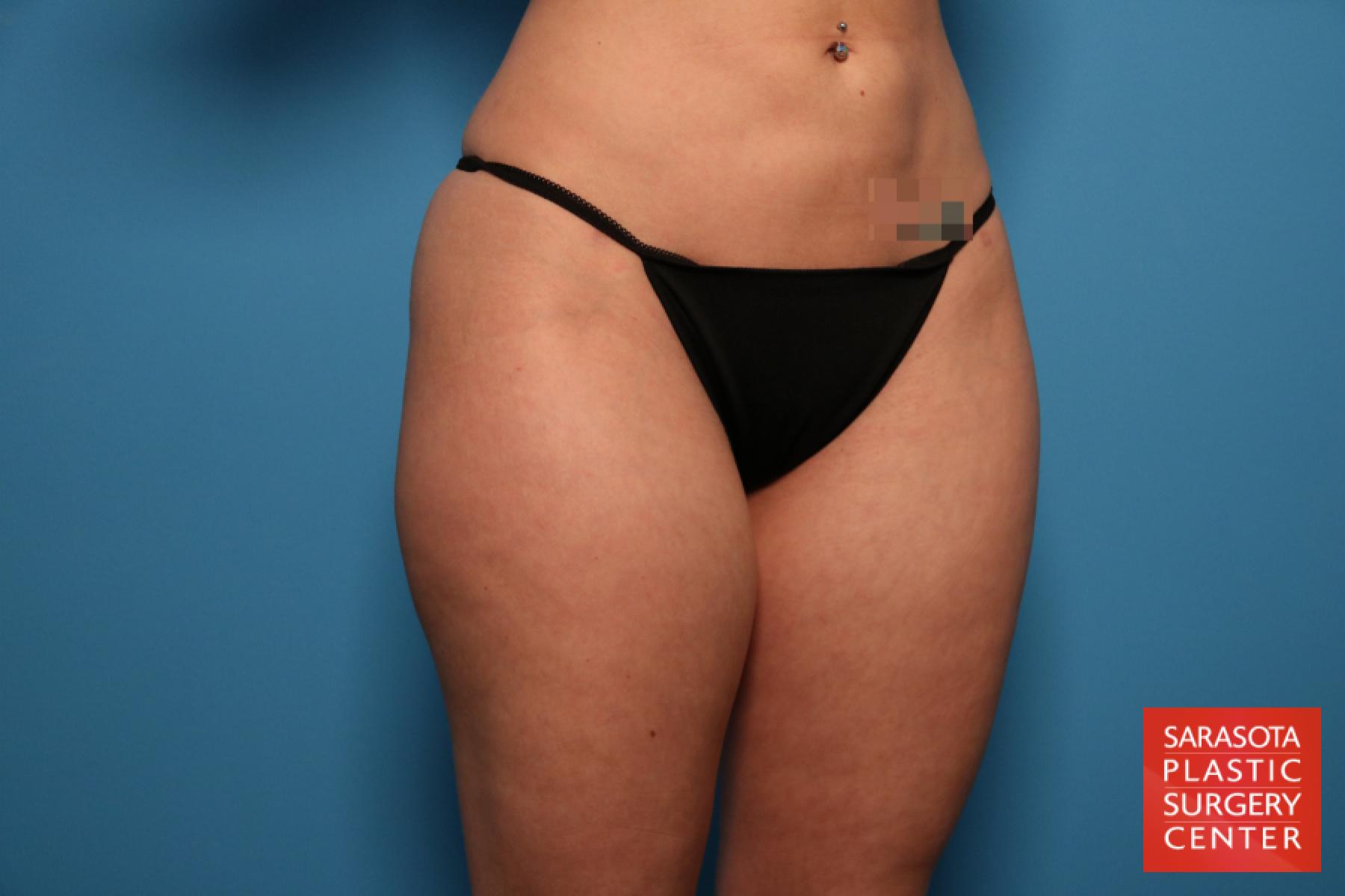 Liposuction: Patient 5 - Before 3